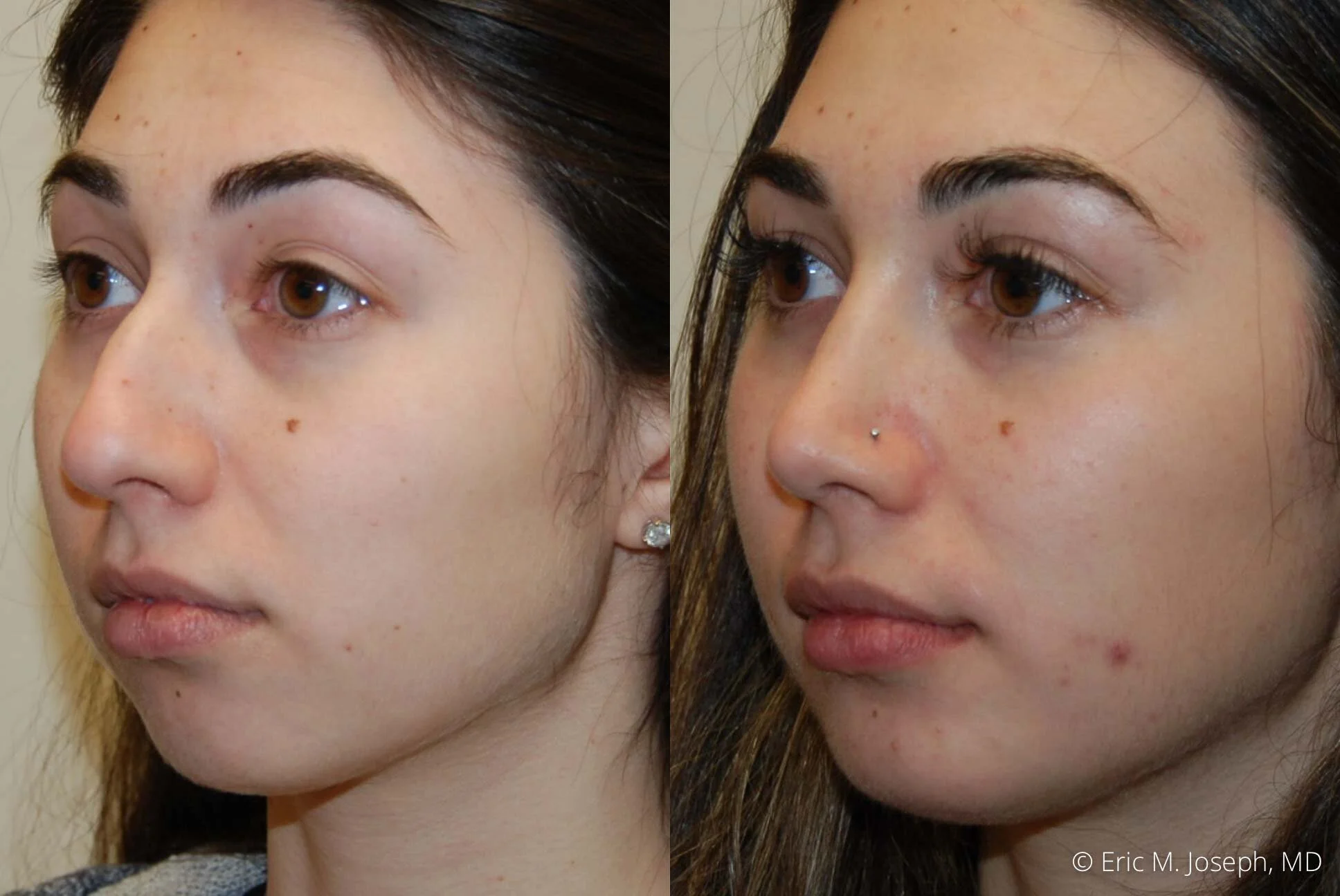 rhinoplasty-nj-expert-nyc-0380.jpg