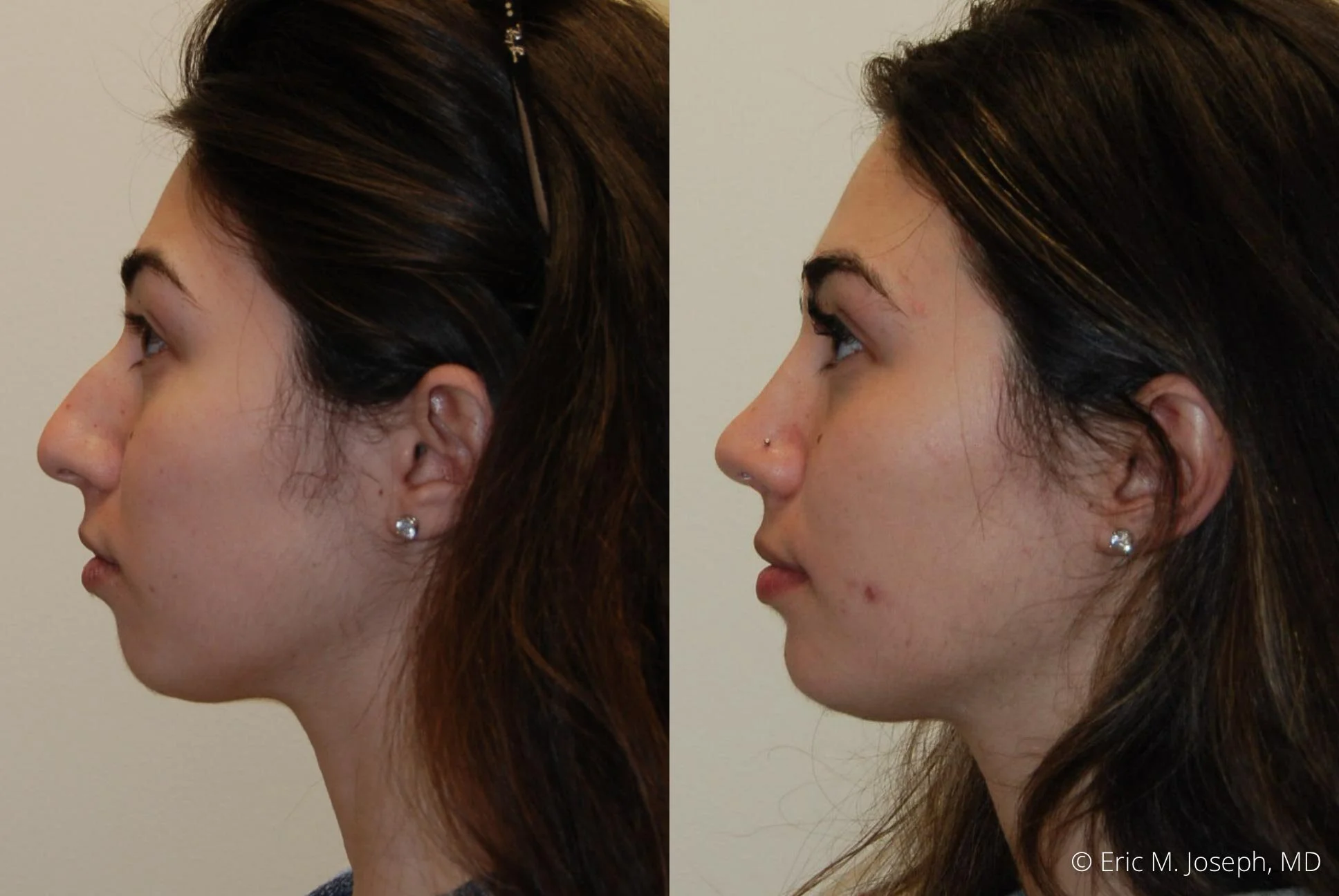 rhinoplasty-nj-expert-nyc-0381.jpg