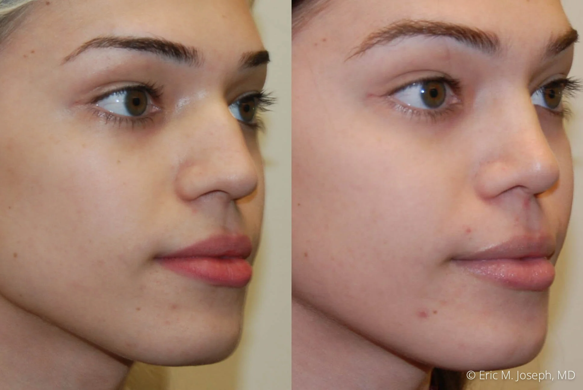 rhinoplasty-nj-expert-nyc-0384.jpg