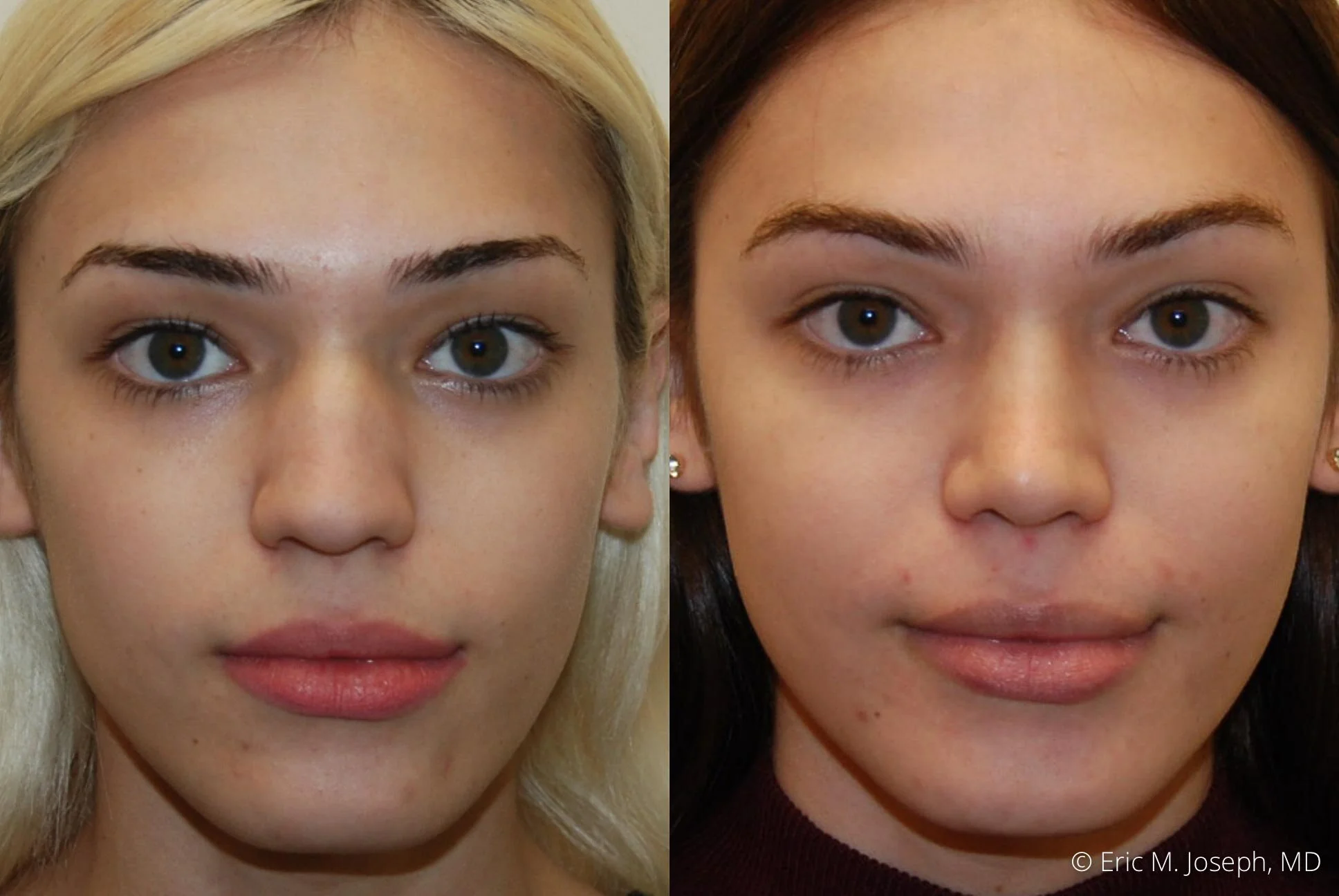 rhinoplasty-nj-expert-nyc-0383.jpg