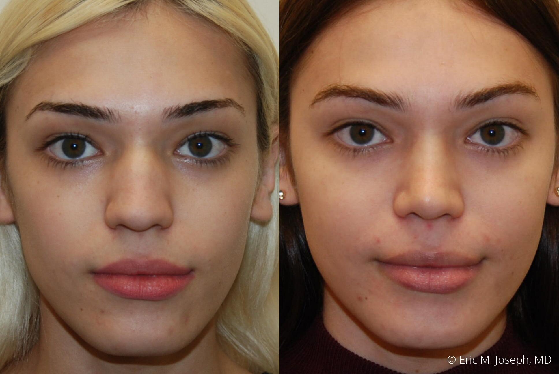 rhinoplasty-nj-expert-nyc-0383.jpg