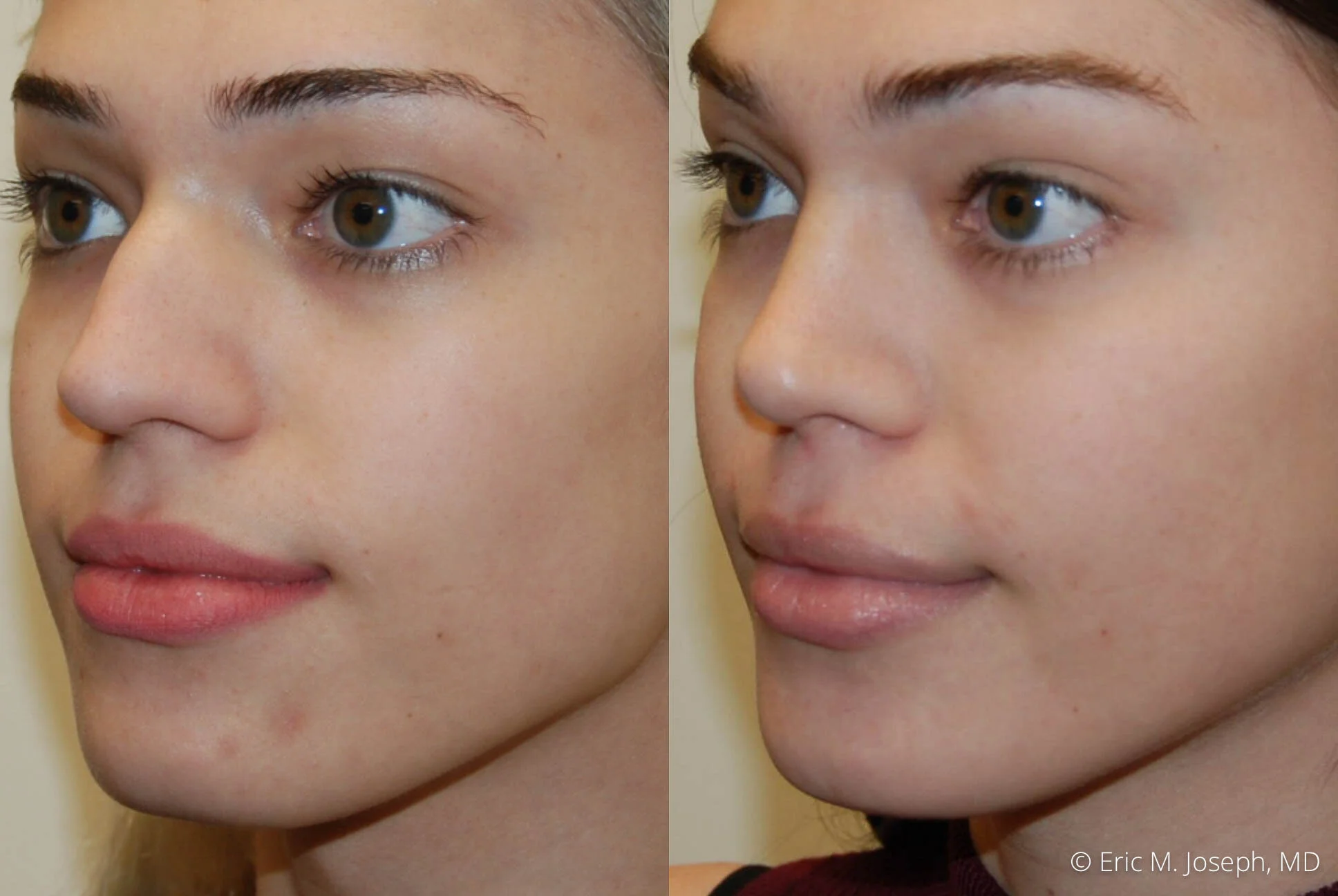 rhinoplasty-nj-expert-nyc-0385.jpg