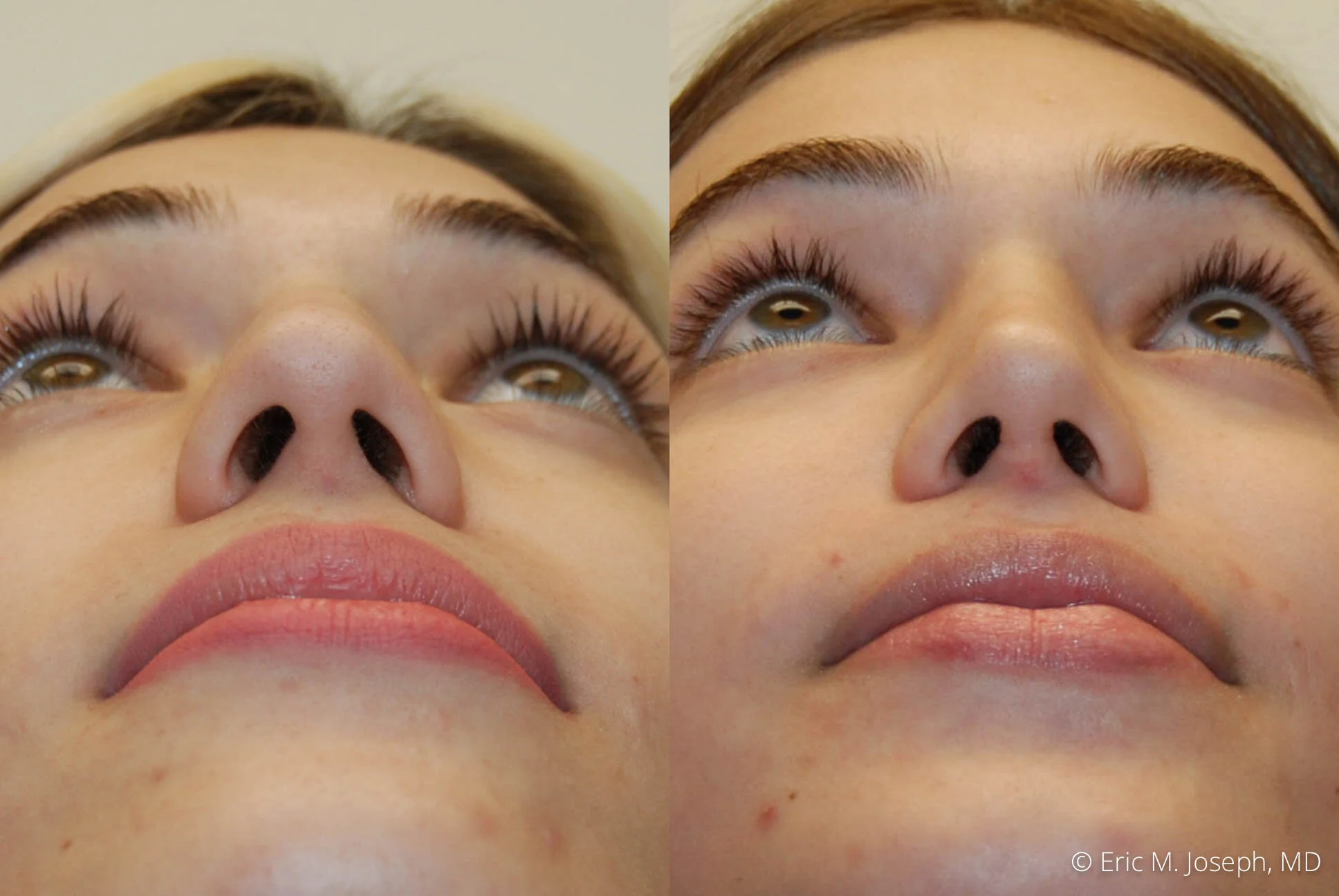 rhinoplasty-nj-expert-nyc-0388.jpg