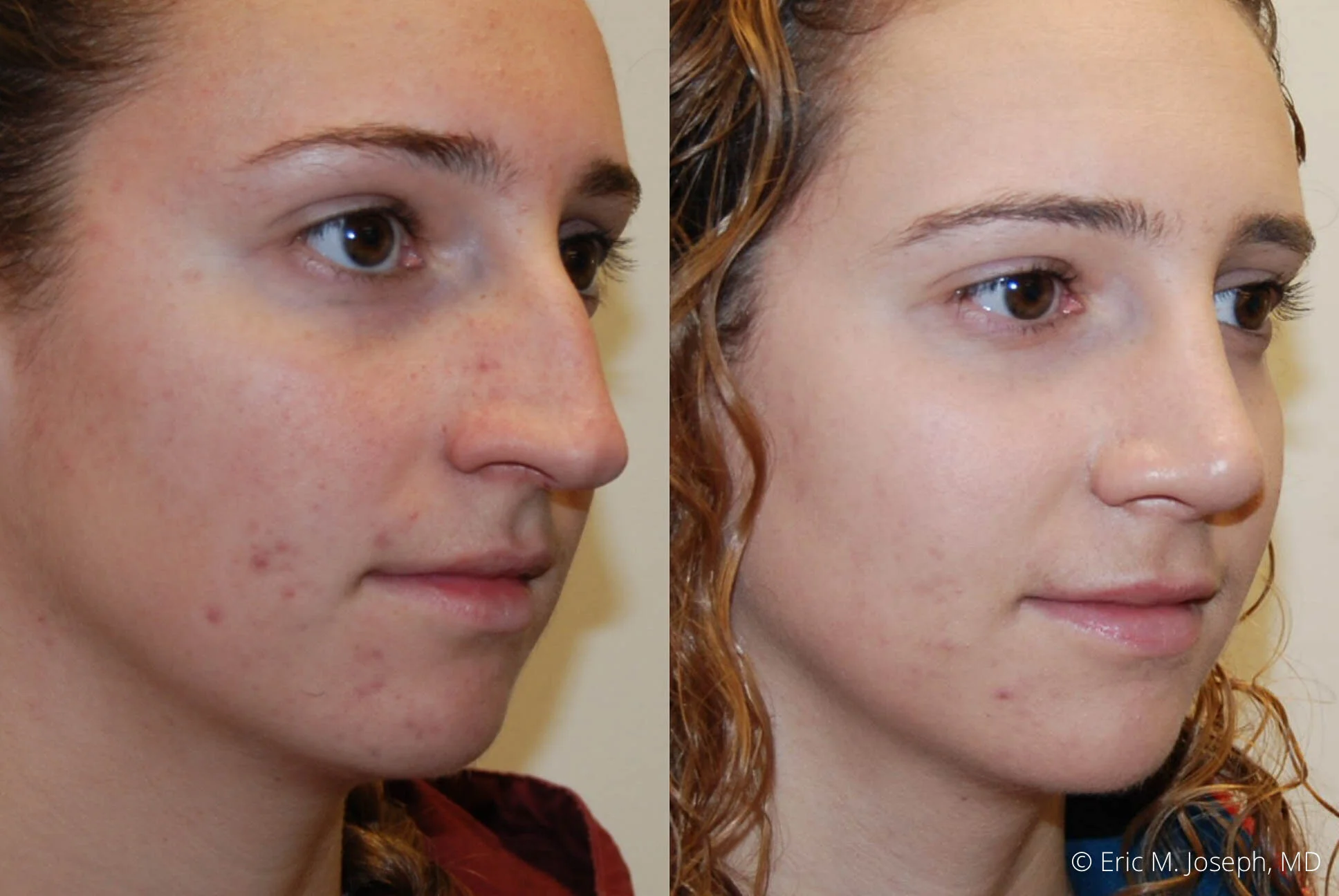 rhinoplasty-nj-expert-nyc-0390.jpg