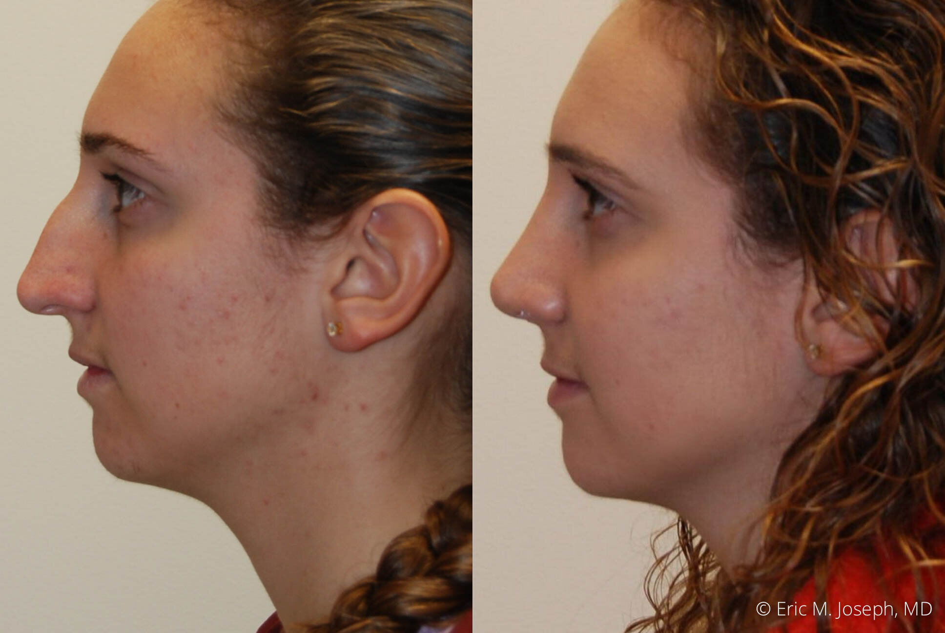 rhinoplasty-nj-expert-nyc-0392.jpg