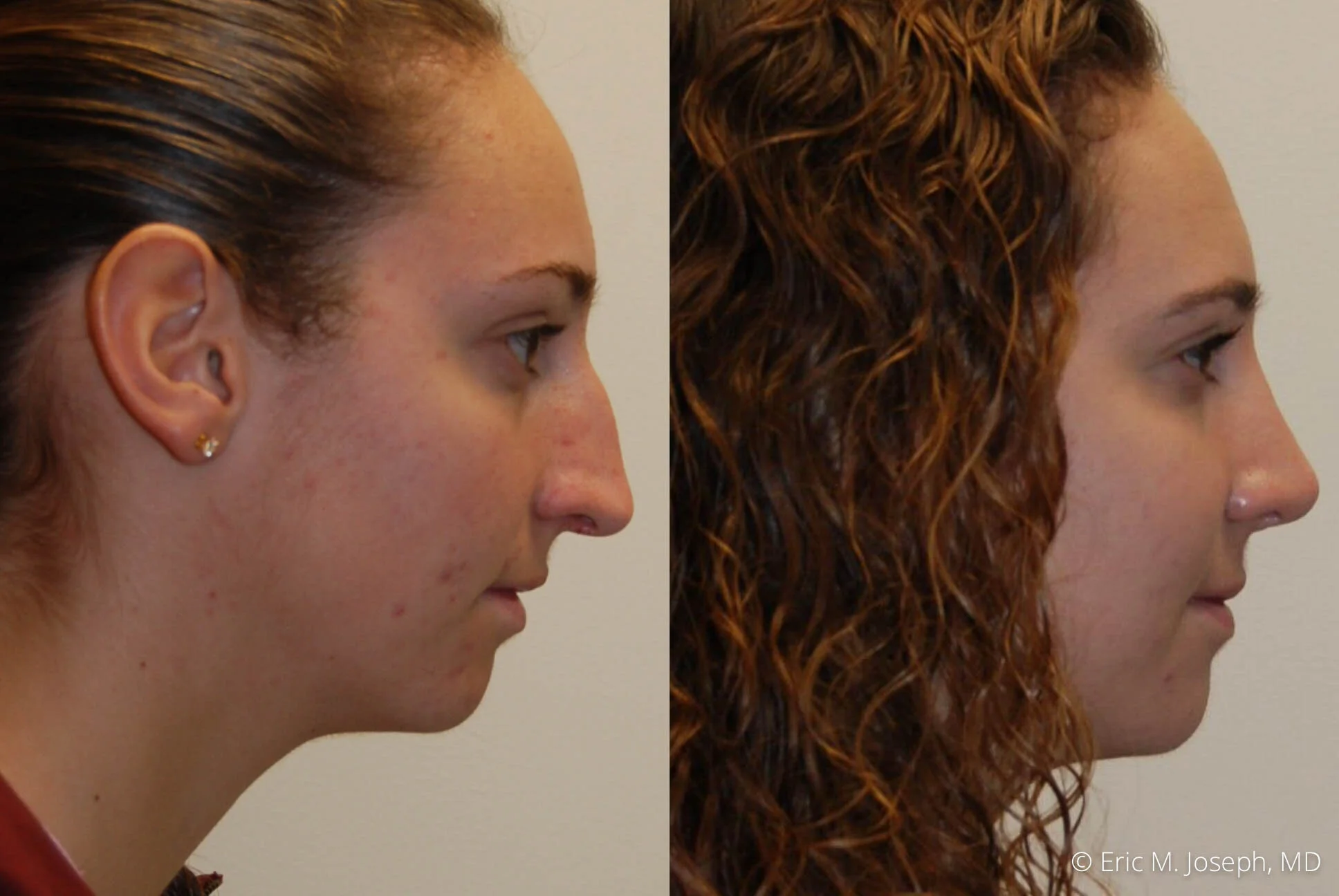 rhinoplasty-nj-expert-nyc-0393.jpg