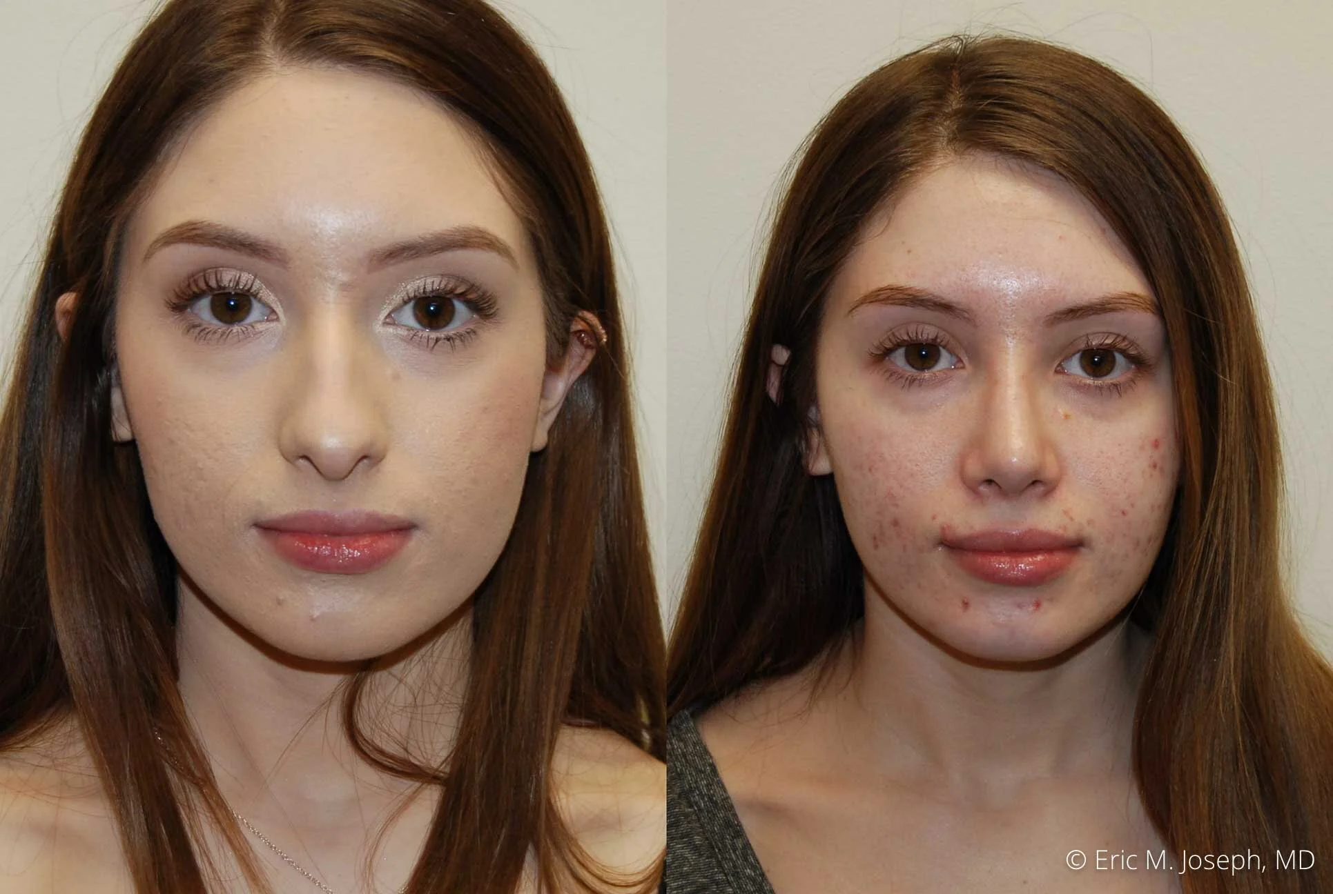 rhinoplasty-nose-job-nyc-nj-0470.jpg