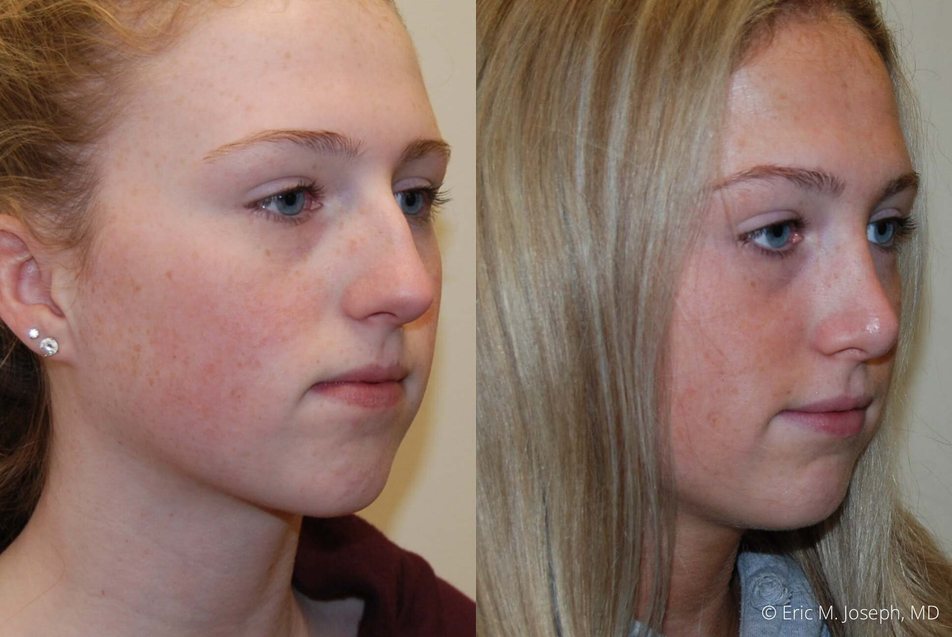 rhinoplasty-nose-job-nj-0486.jpg