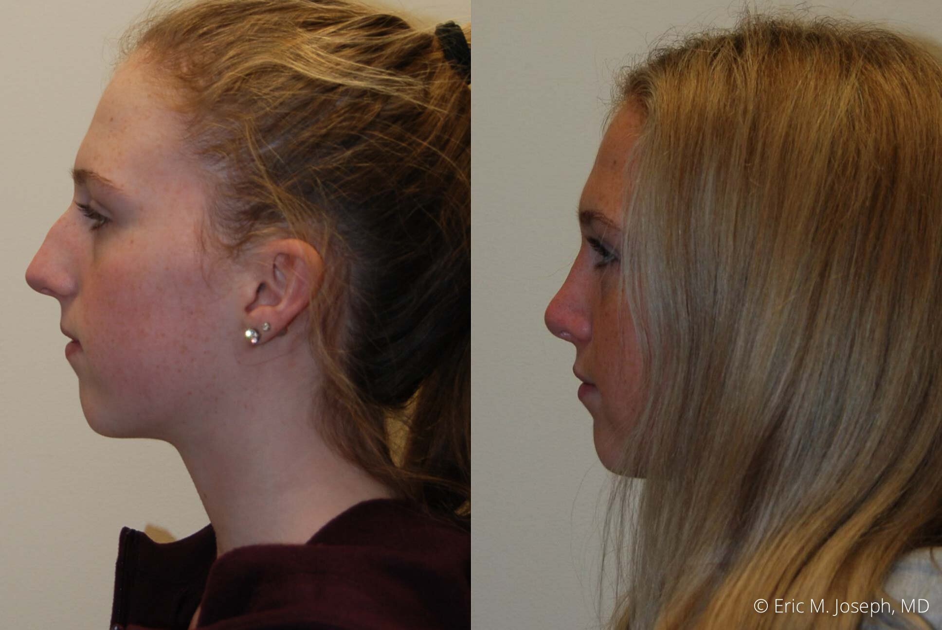 rhinoplasty-nose-job-nj-0488.jpg