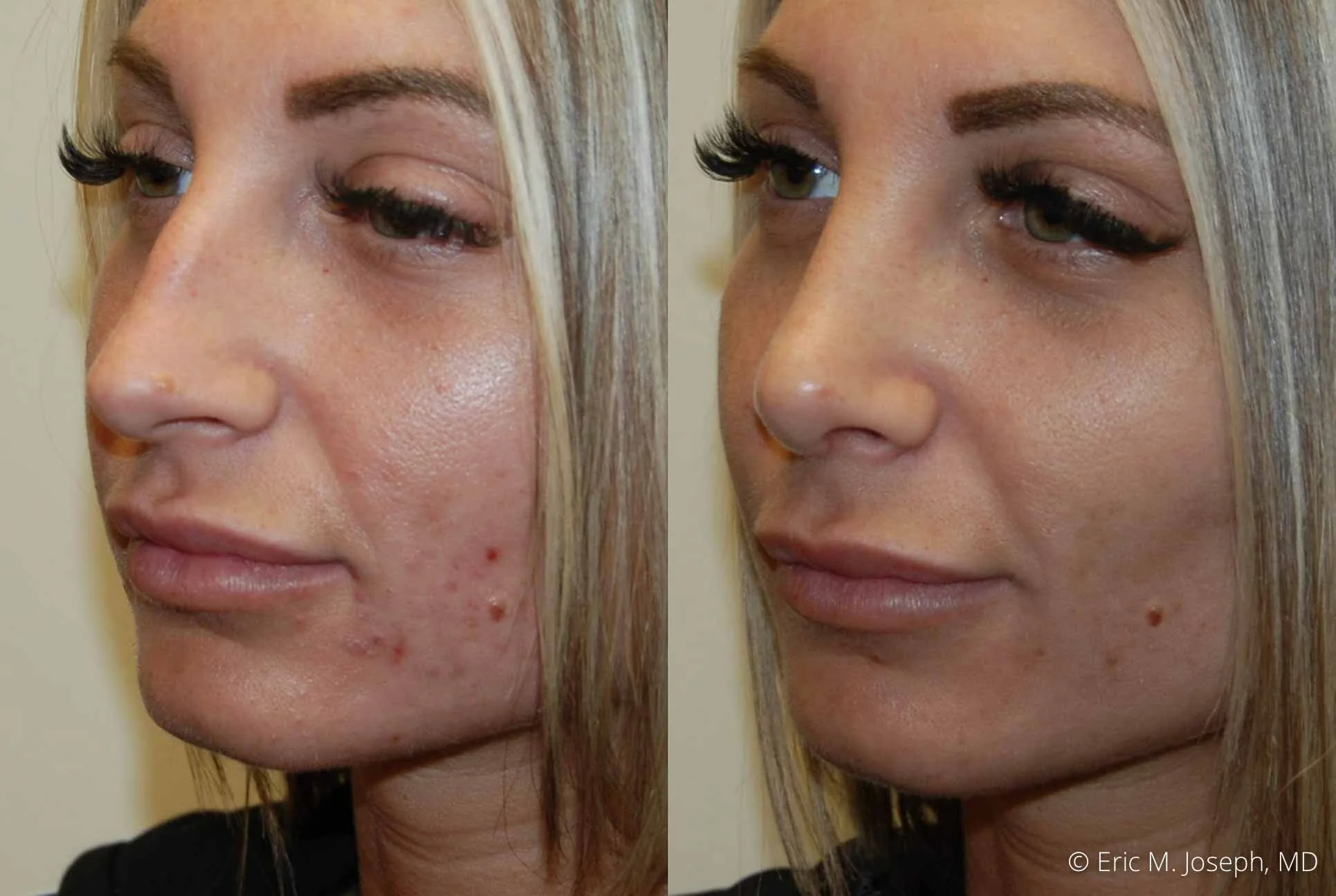 rhinoplasty-nj-nose-job-0542.jpg