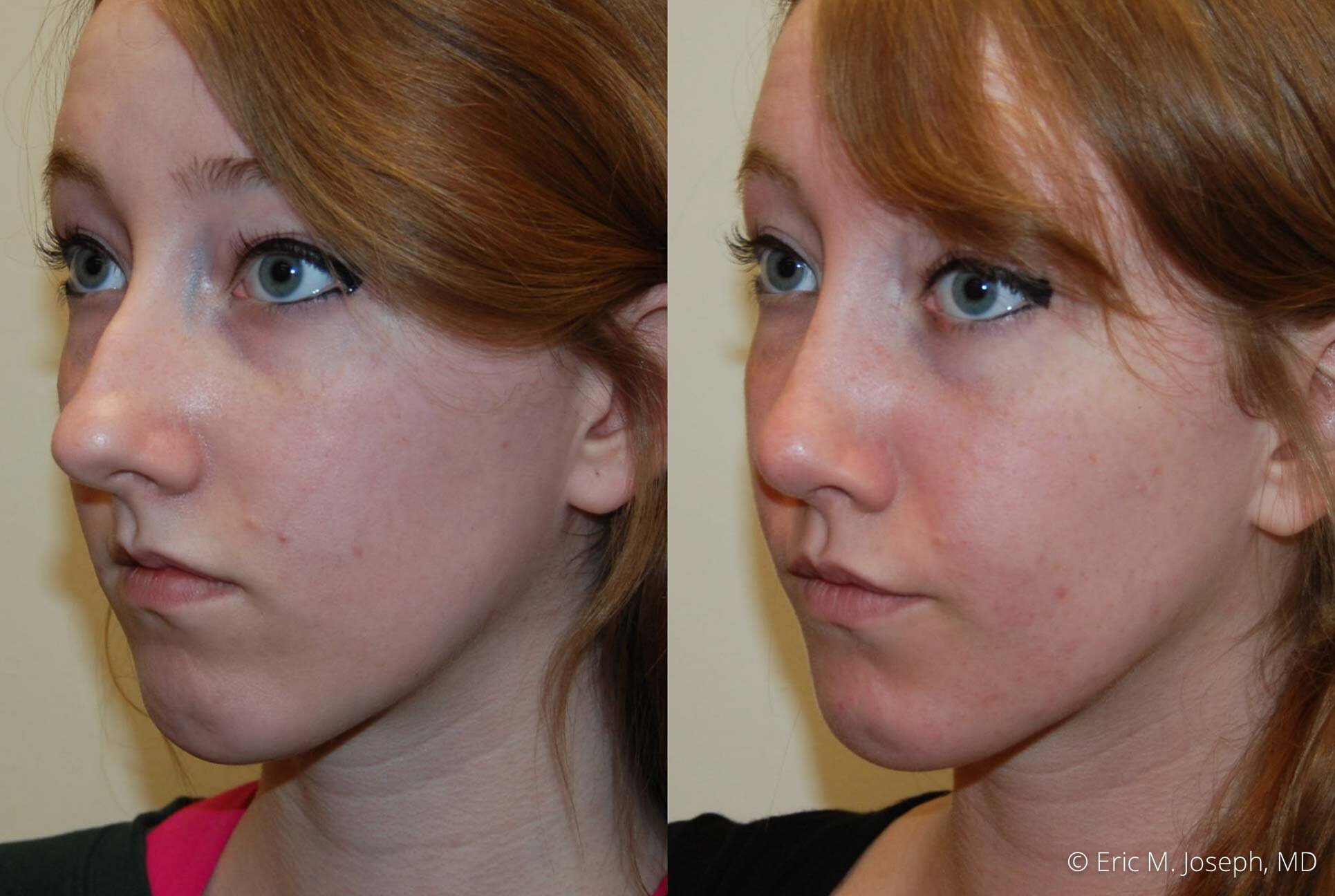 rhinoplasty-nj-0512.jpg