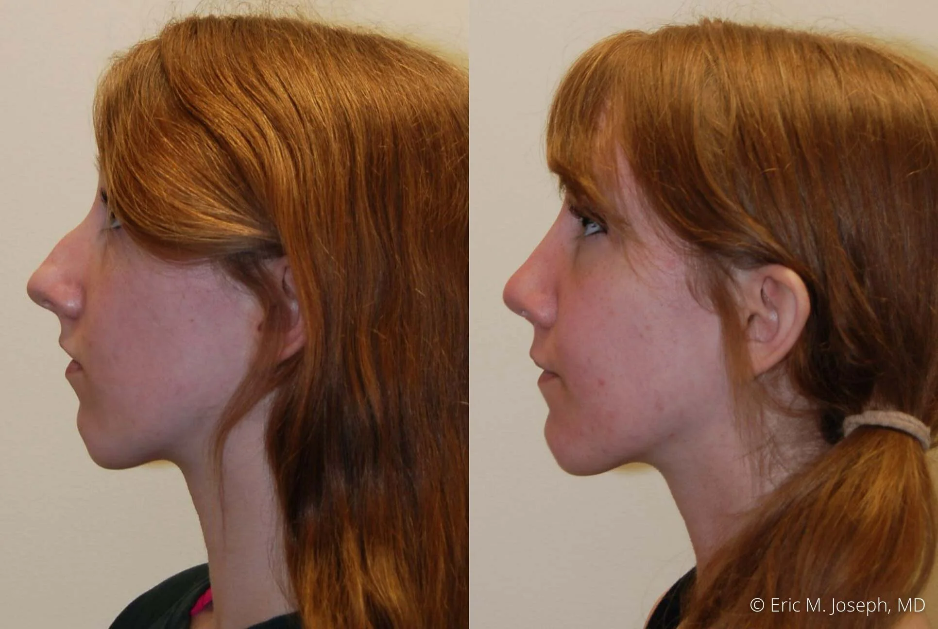 rhinoplasty-nj-0513.jpg