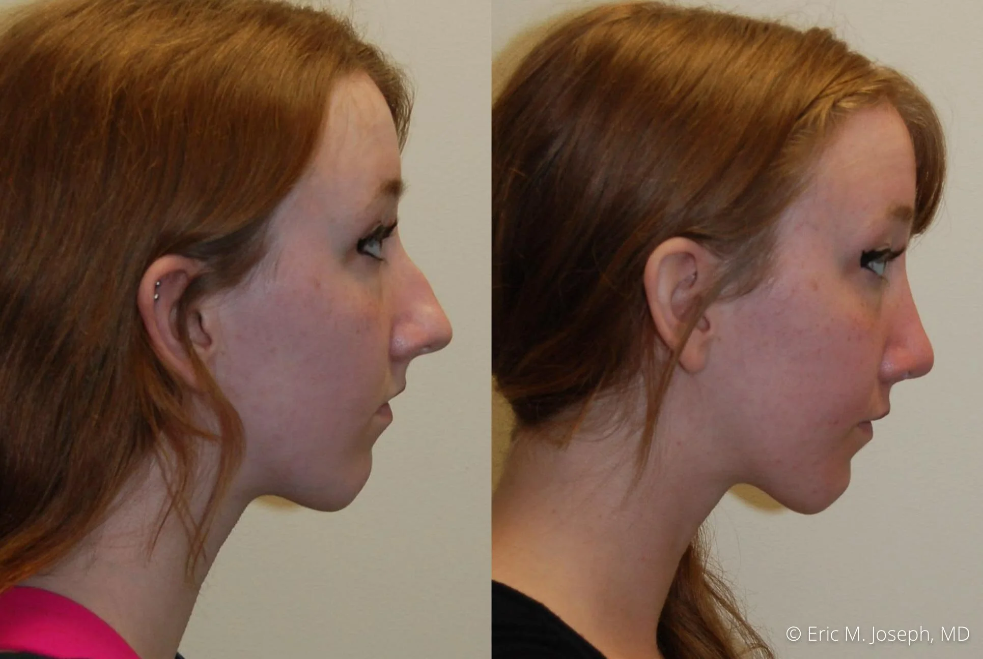 rhinoplasty-nj-0514.jpg
