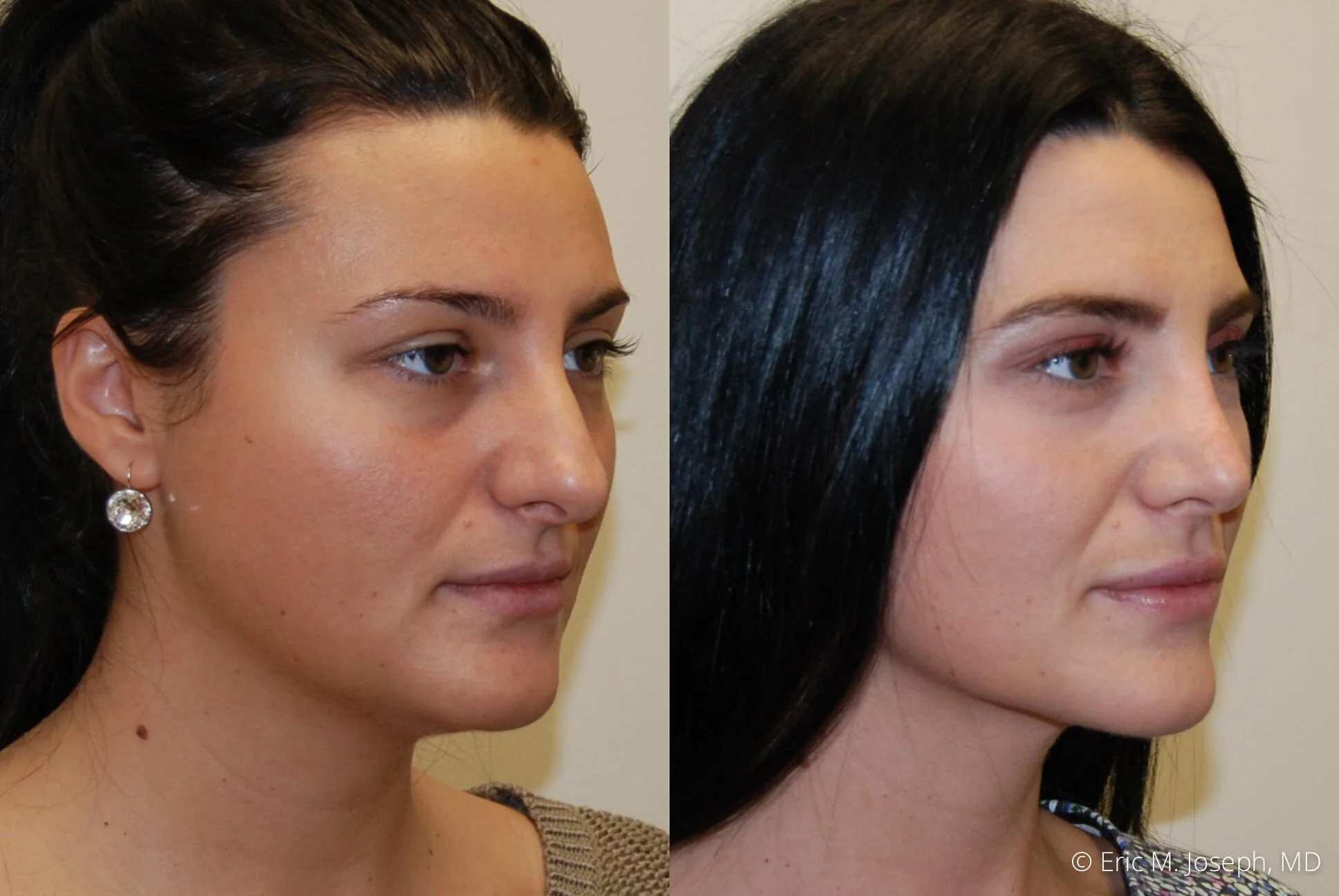 rhinoplasty-nj-nyc-natural-expert-0439.jpg