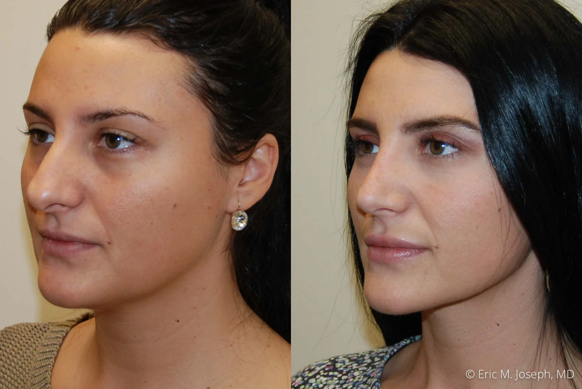 rhinoplasty-nj-nyc-natural-expert-0440.jpg