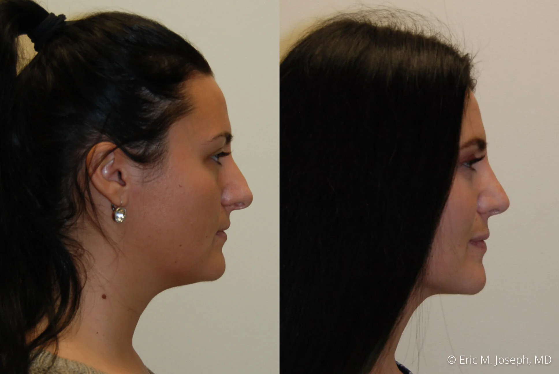 rhinoplasty-nj-nyc-natural-expert-0442.jpg