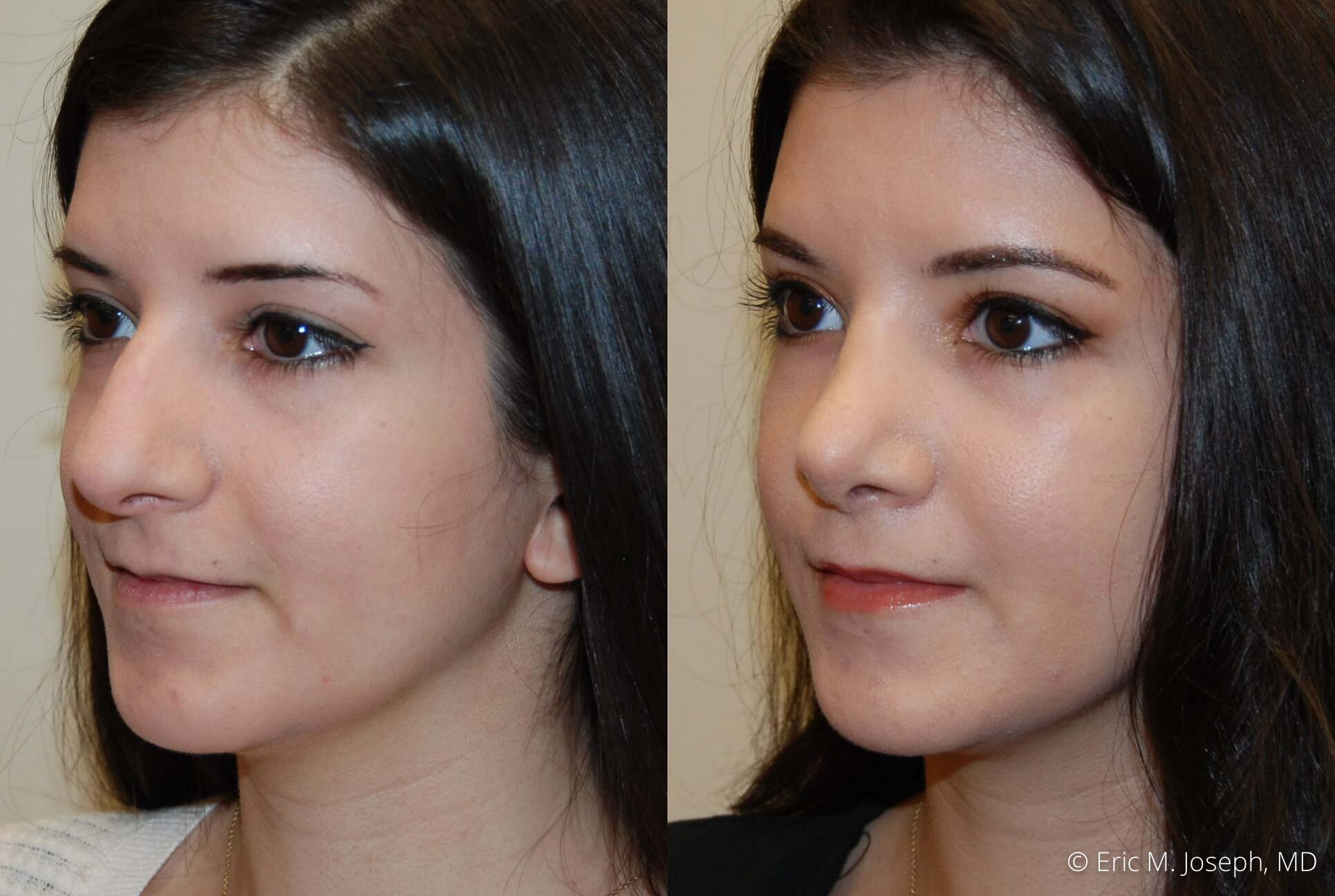 rhinoplasty-nose-job-nyc-nj-0481.jpg