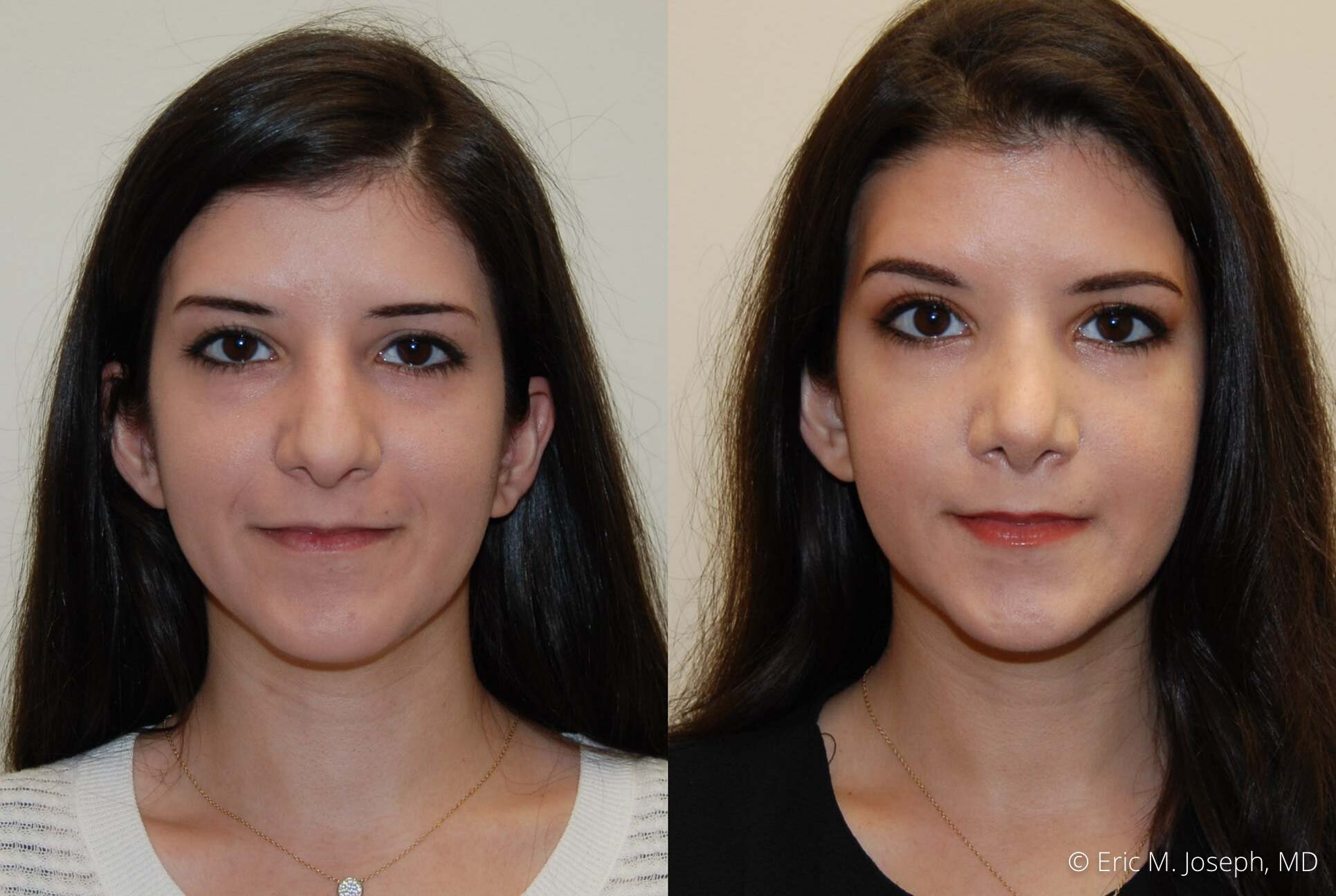 rhinoplasty-nose-job-nyc-nj-0480.jpg