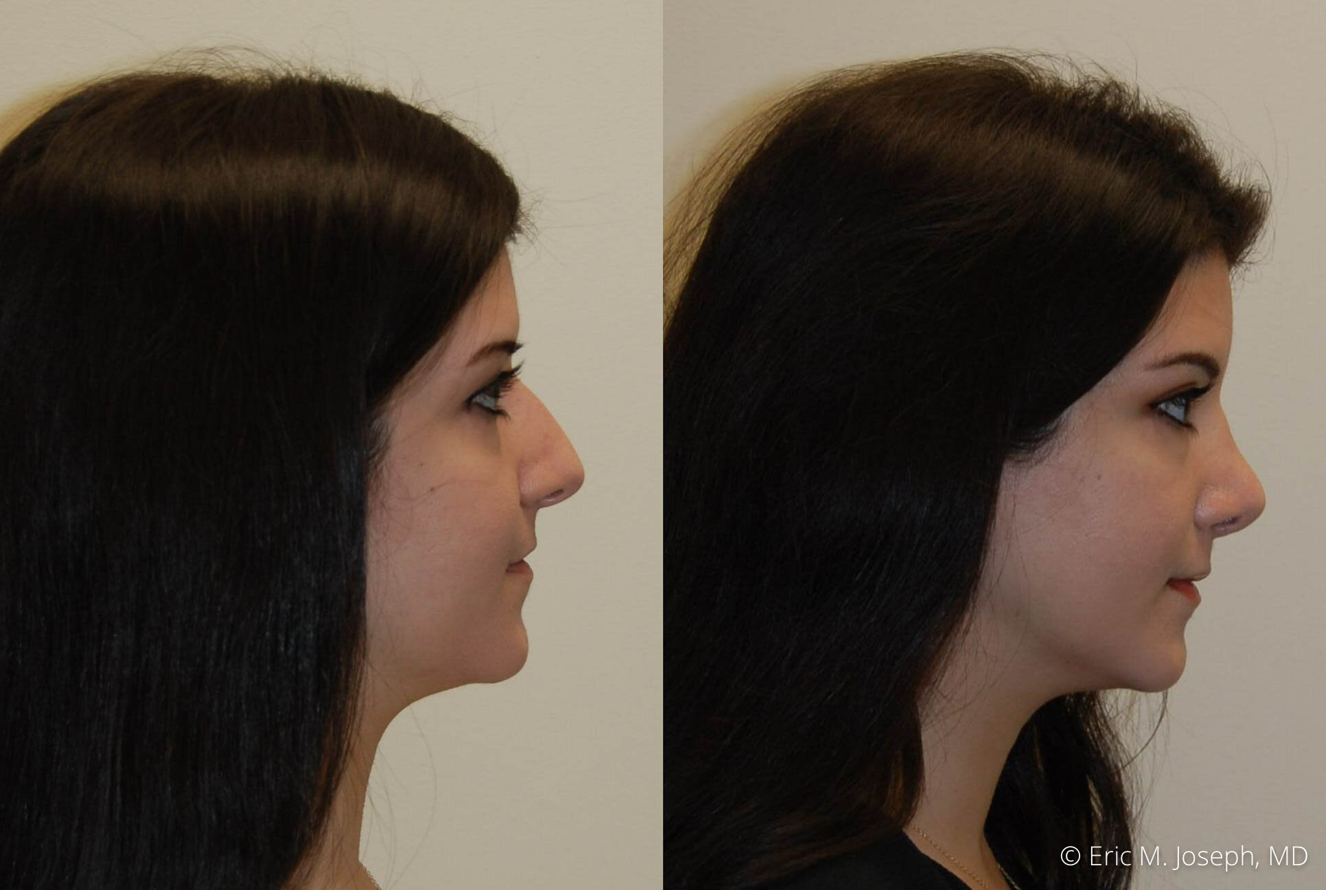 rhinoplasty-nose-job-nyc-nj-0484.jpg