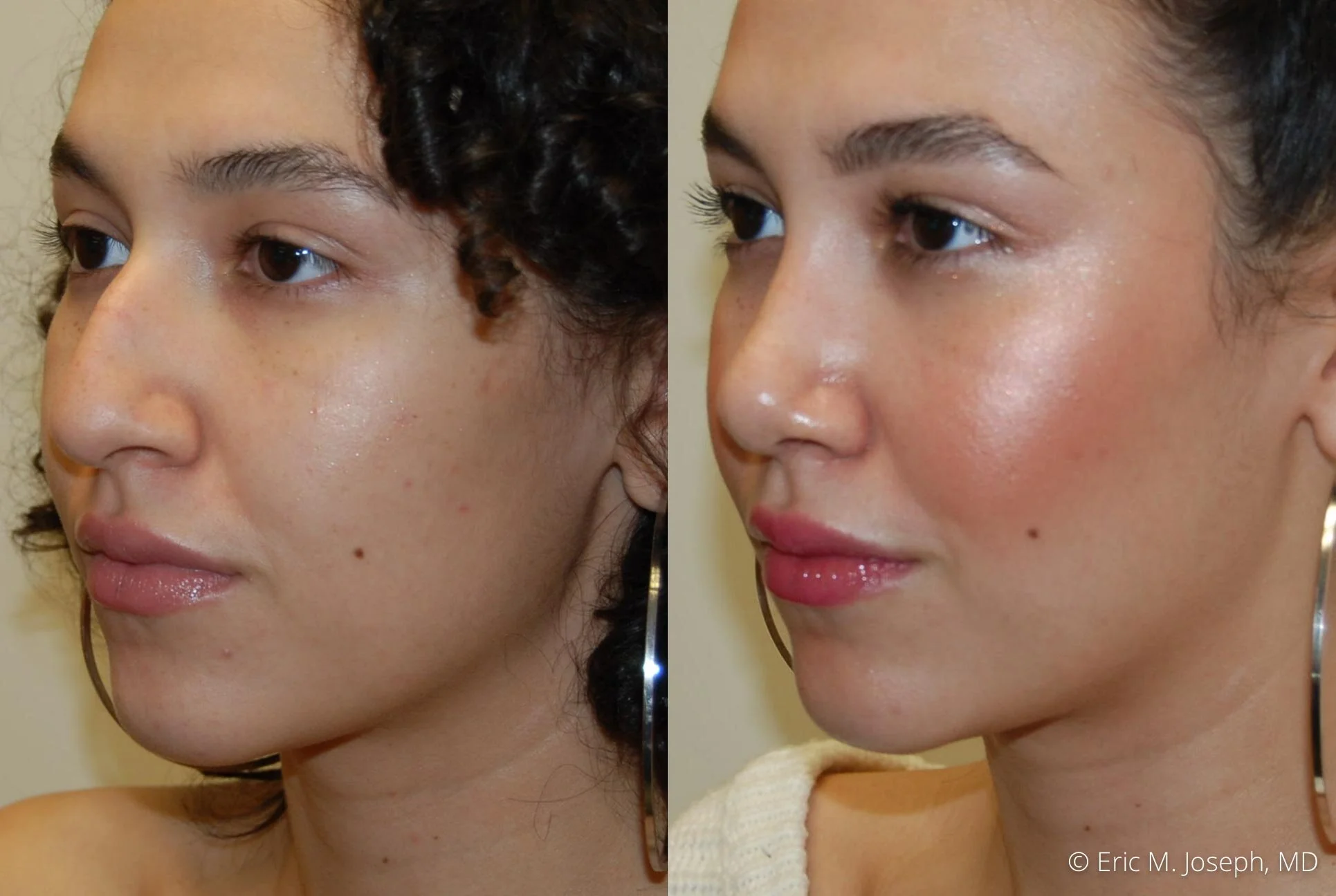 rhinoplasty-nose-job-nj-0492.jpg