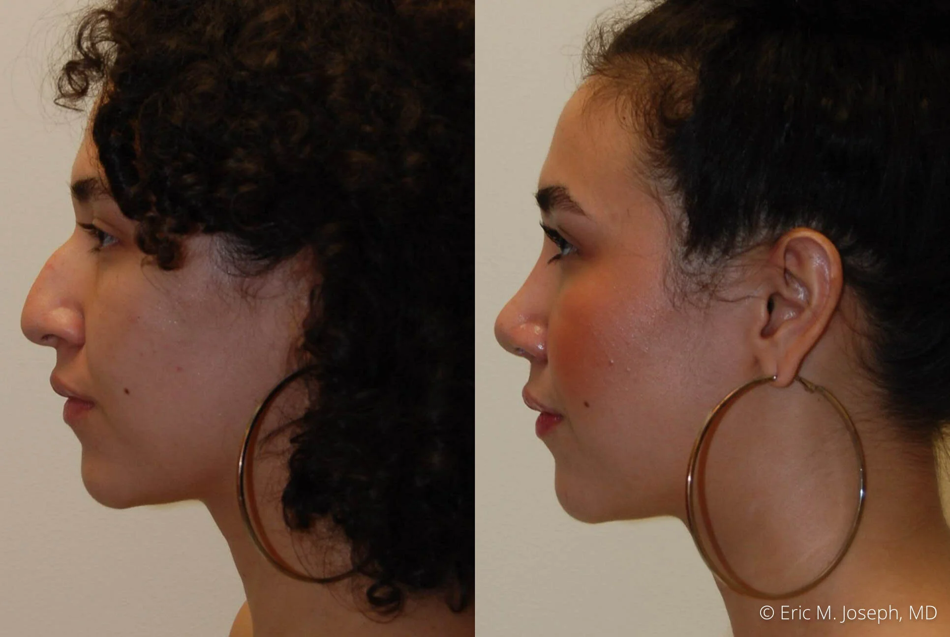 rhinoplasty-nose-job-nj-0493.jpg
