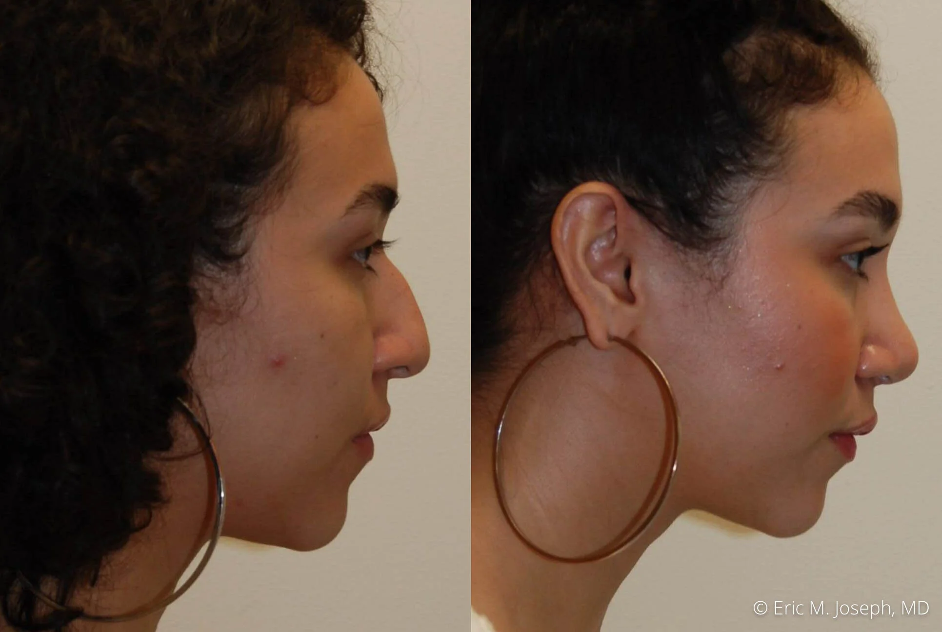 rhinoplasty-nose-job-nj-0494.jpg