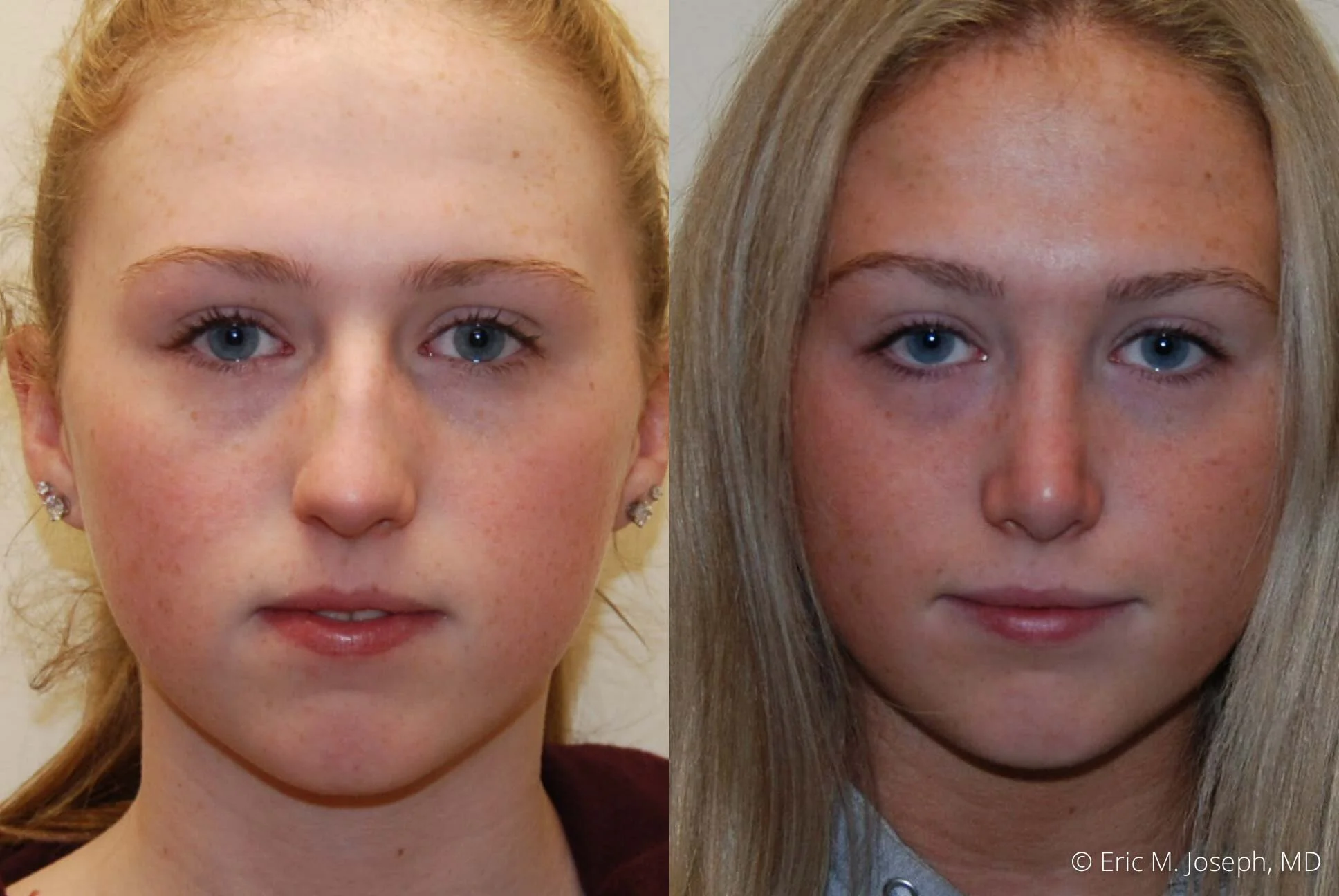 rhinoplasty-nose-job-nj-0495.jpg