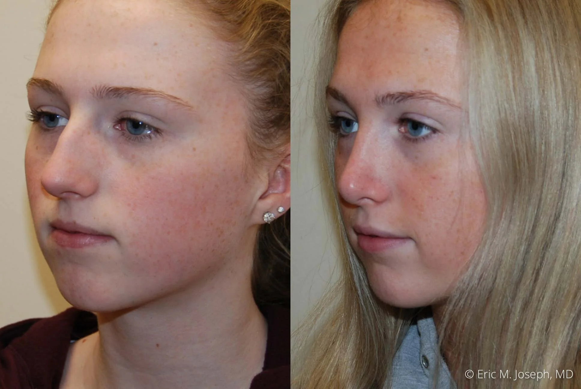 rhinoplasty-nose-job-nj-0497.jpg