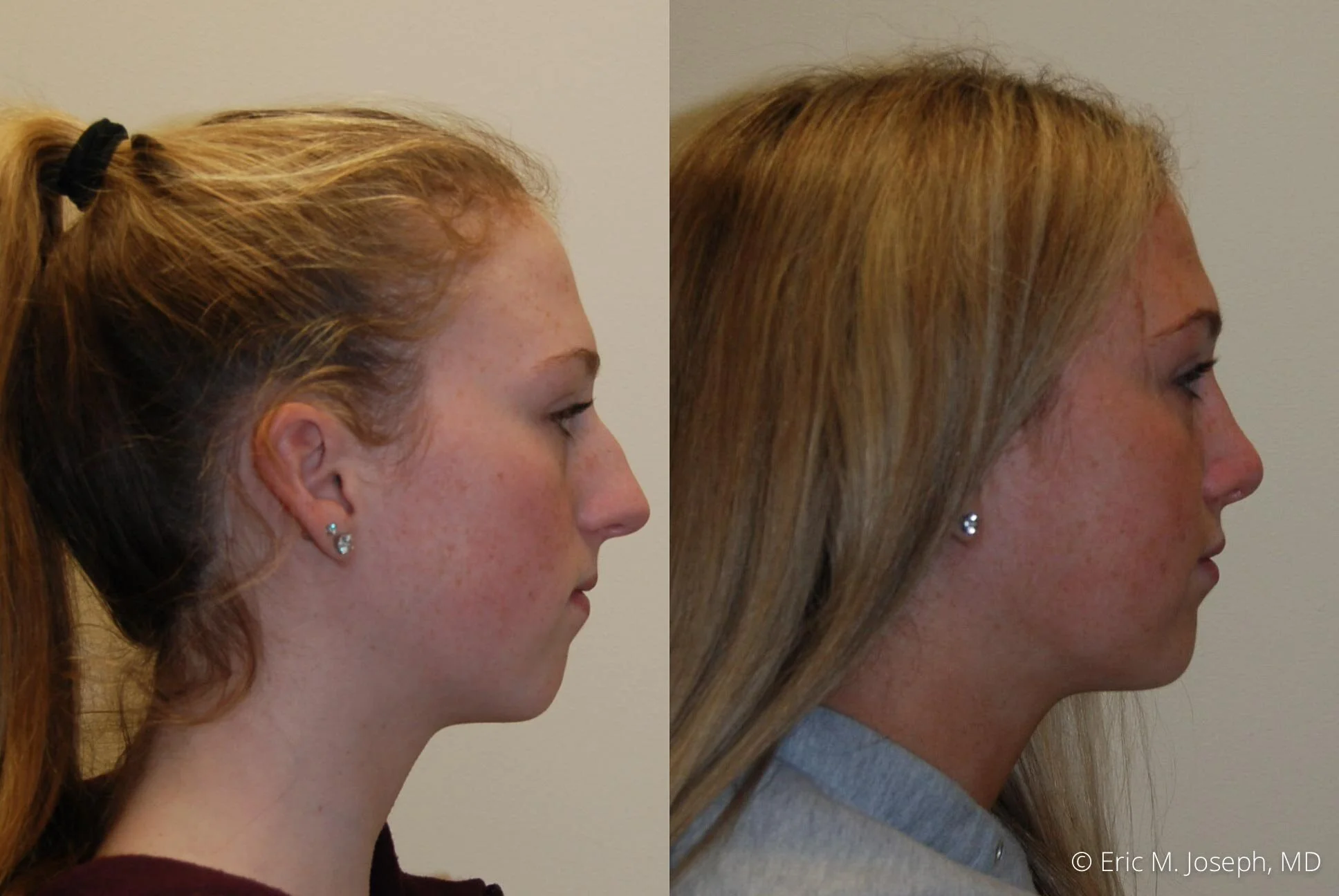rhinoplasty-nose-job-nj-0499.jpg