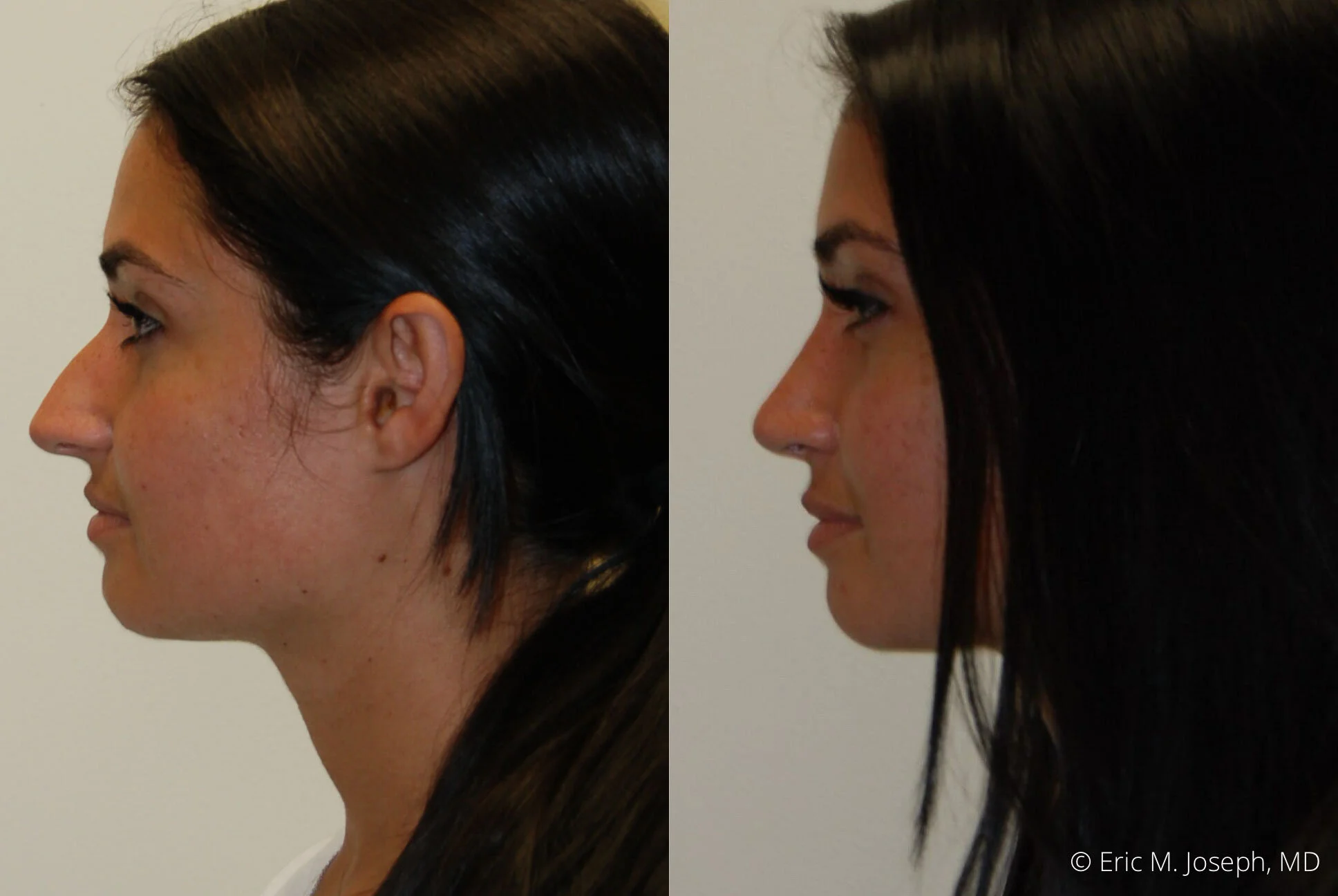 rhinoplasty-nj-nyc-nose-job-0380.jpg