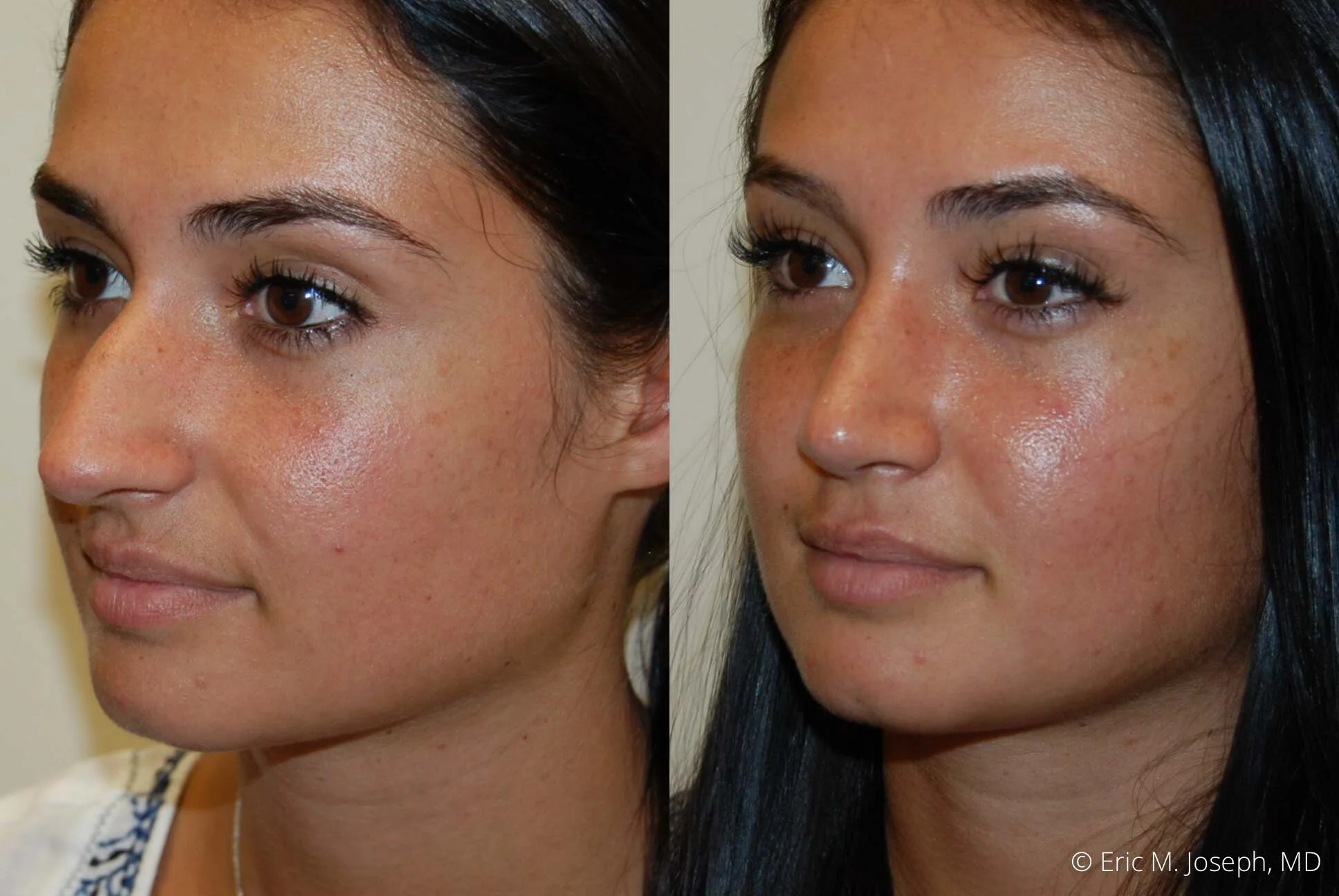 rhinoplasty-nj-nyc-nose-job-0381.jpg
