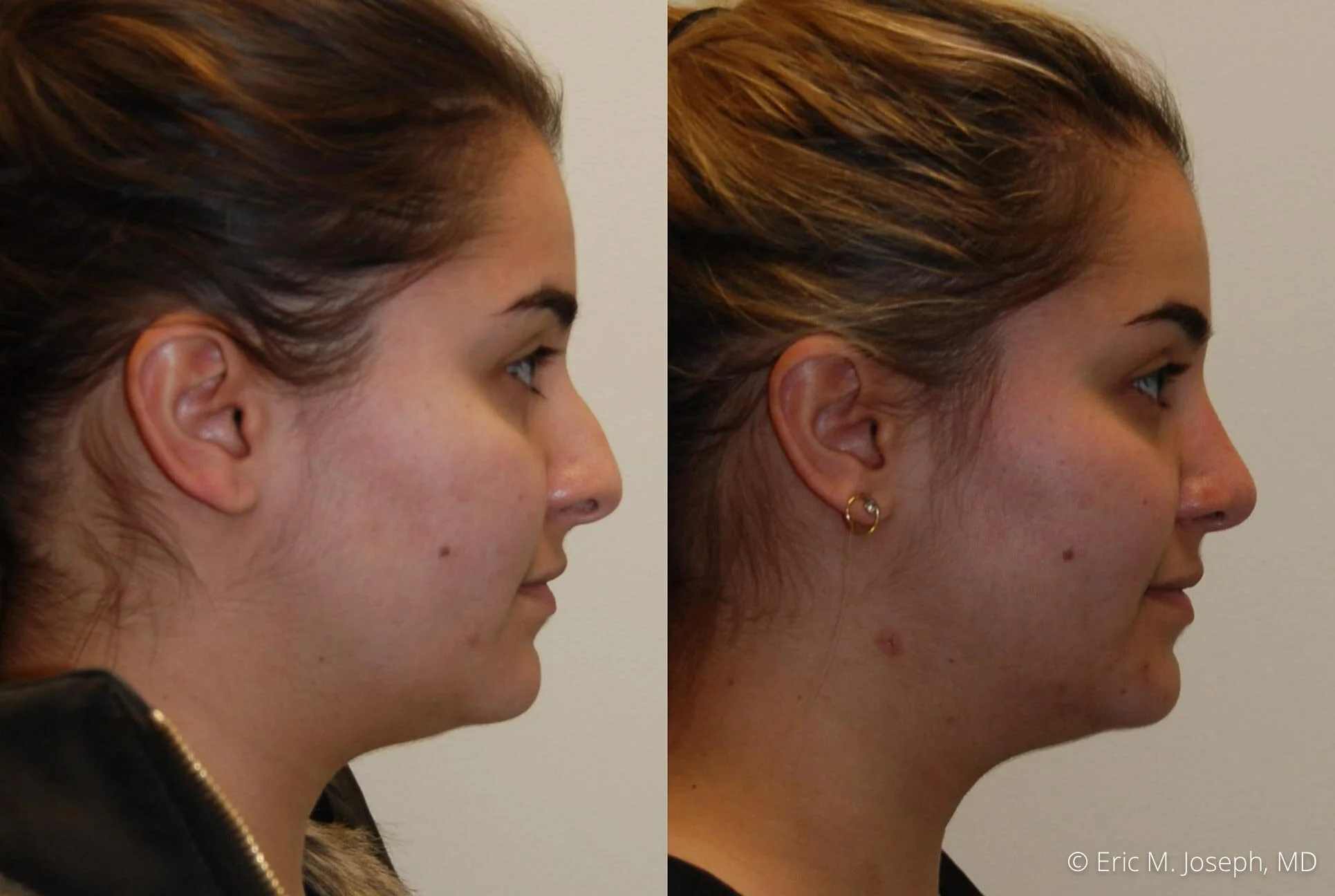 rhinoplasty-nose-job-nyc-nj-0478.jpg