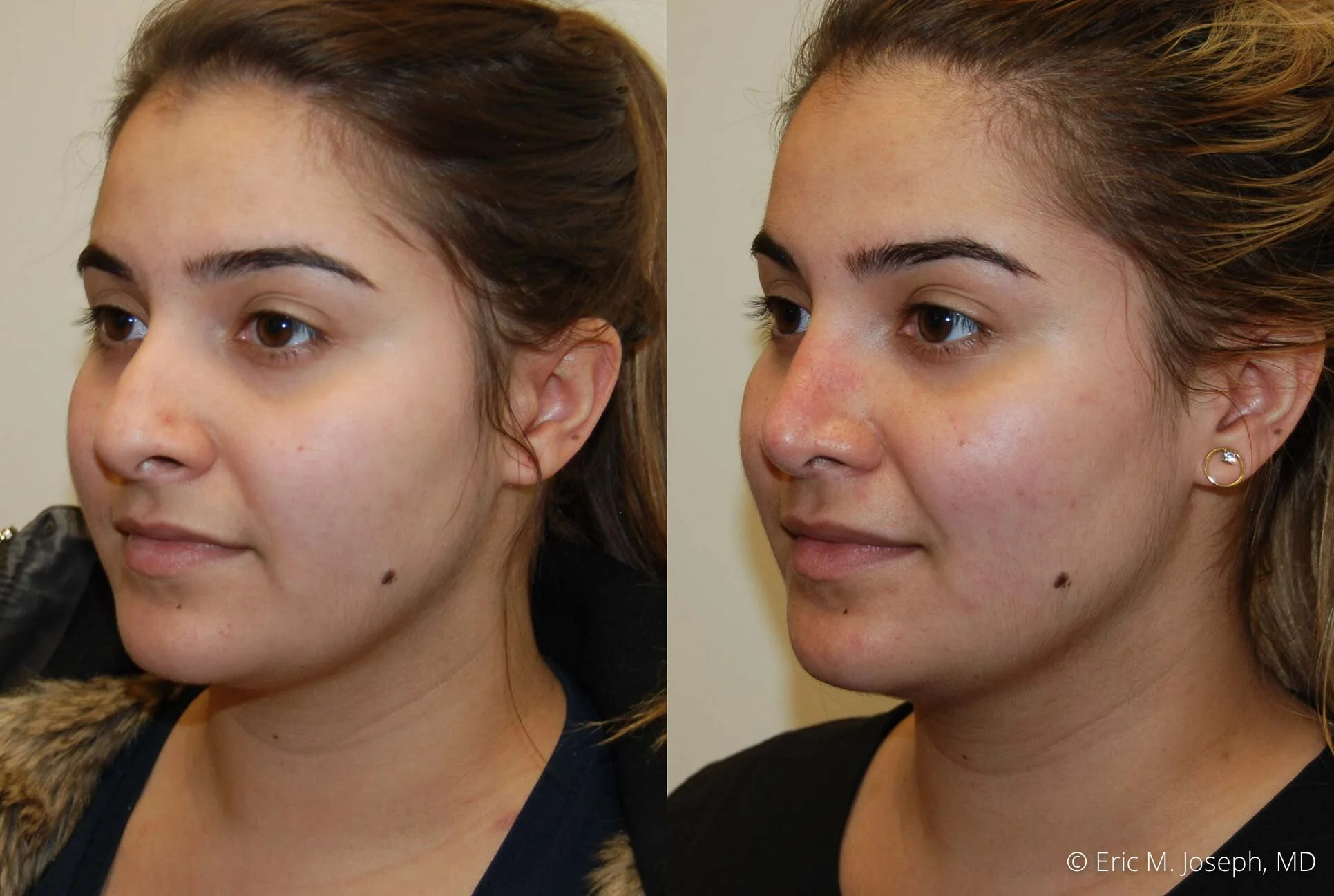 rhinoplasty-nose-job-nyc-nj-0479.jpg
