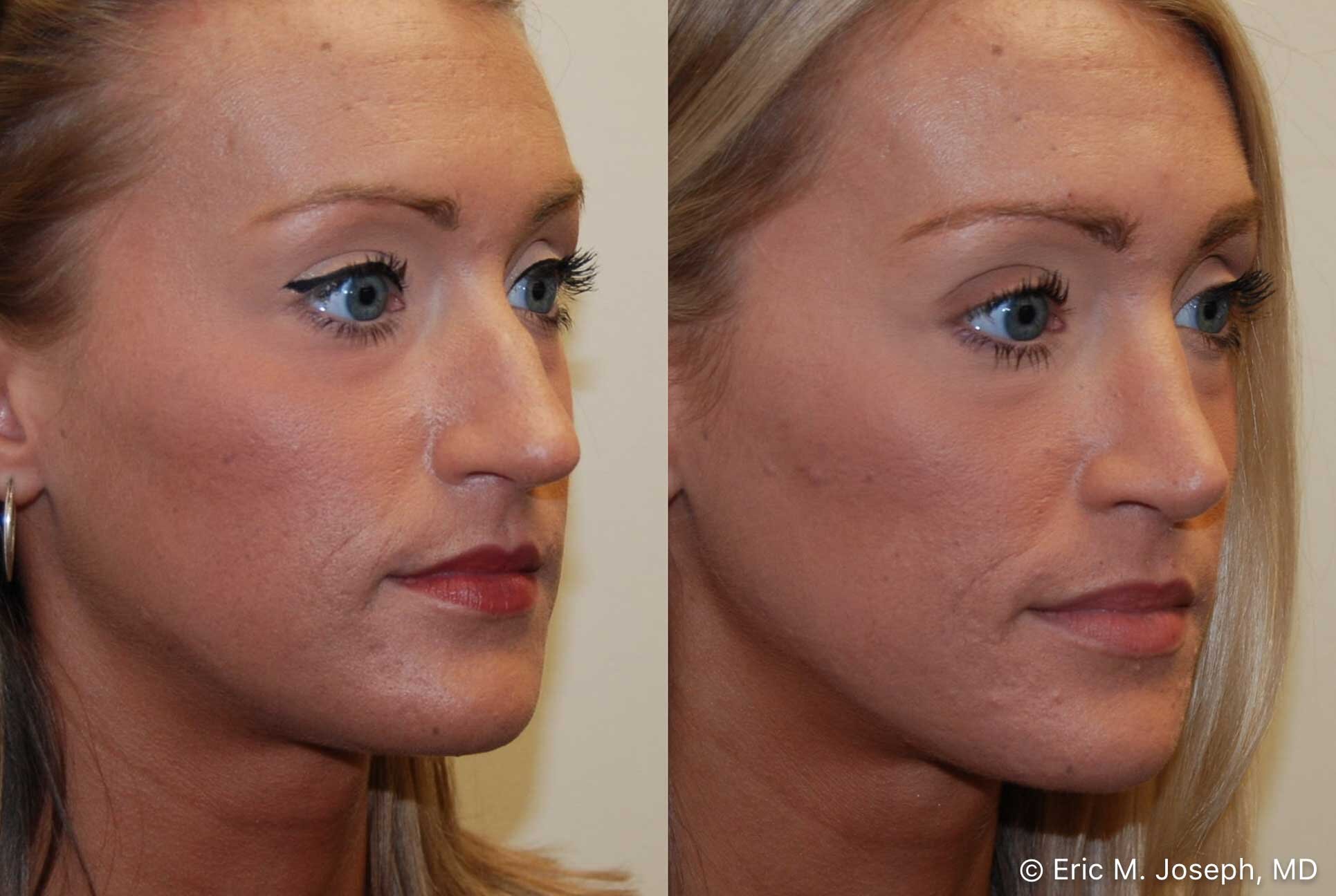 rhinoplasty-nj-nose-job-nyc-0555.jpg