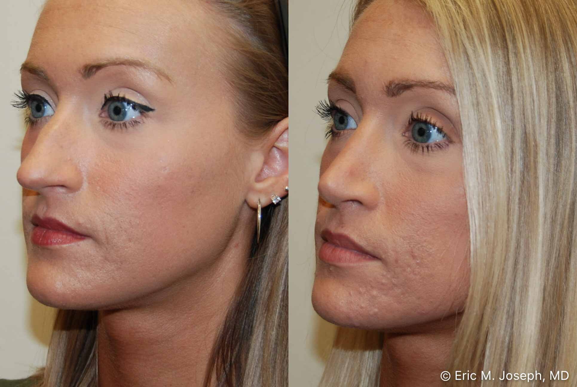 rhinoplasty-nj-nose-job-nyc-0556.jpg