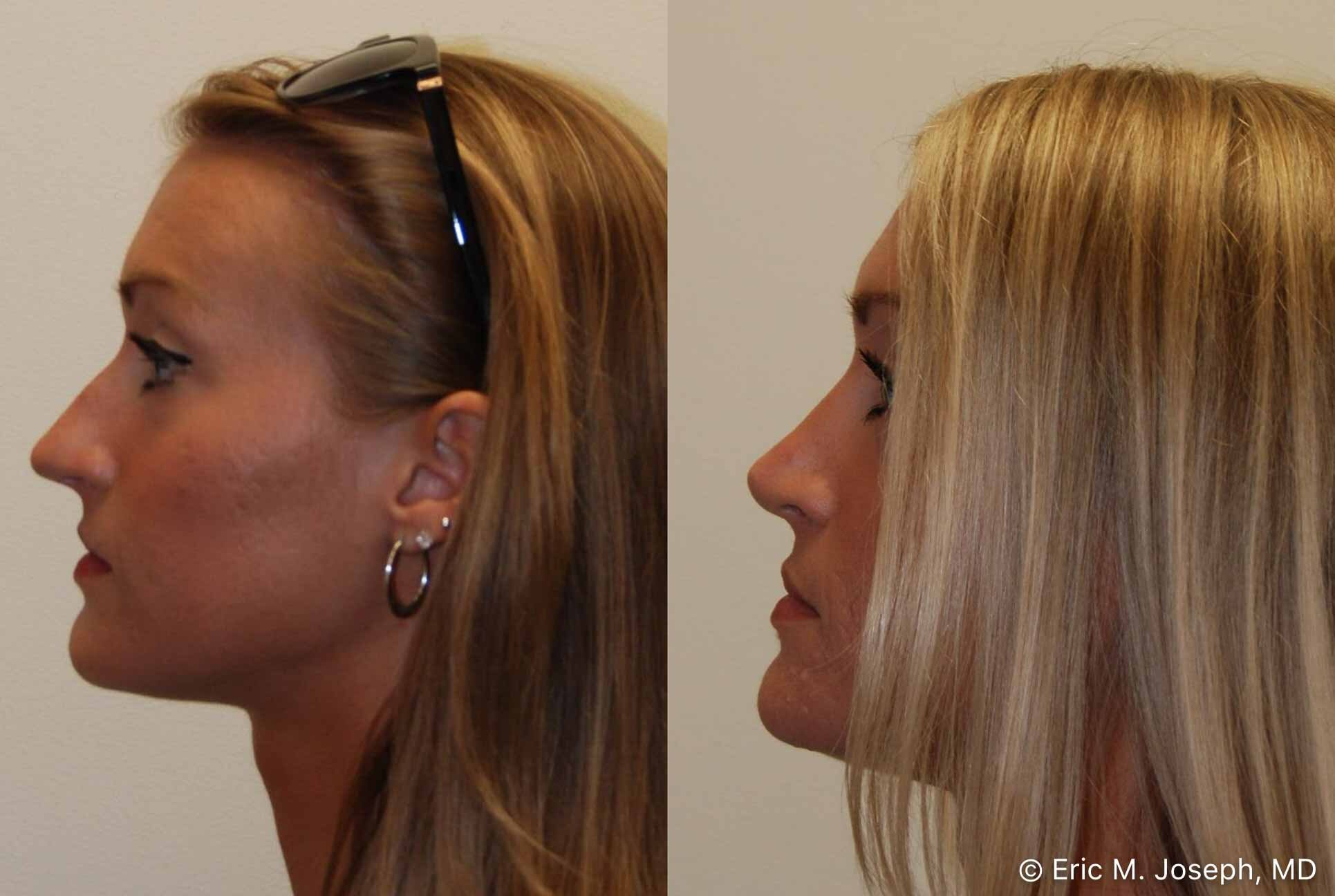 rhinoplasty-nj-nose-job-nyc-0557.jpg