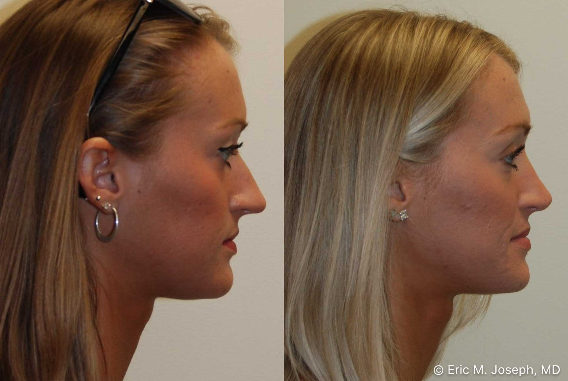 rhinoplasty-nj-nose-job-nyc-0558.jpg