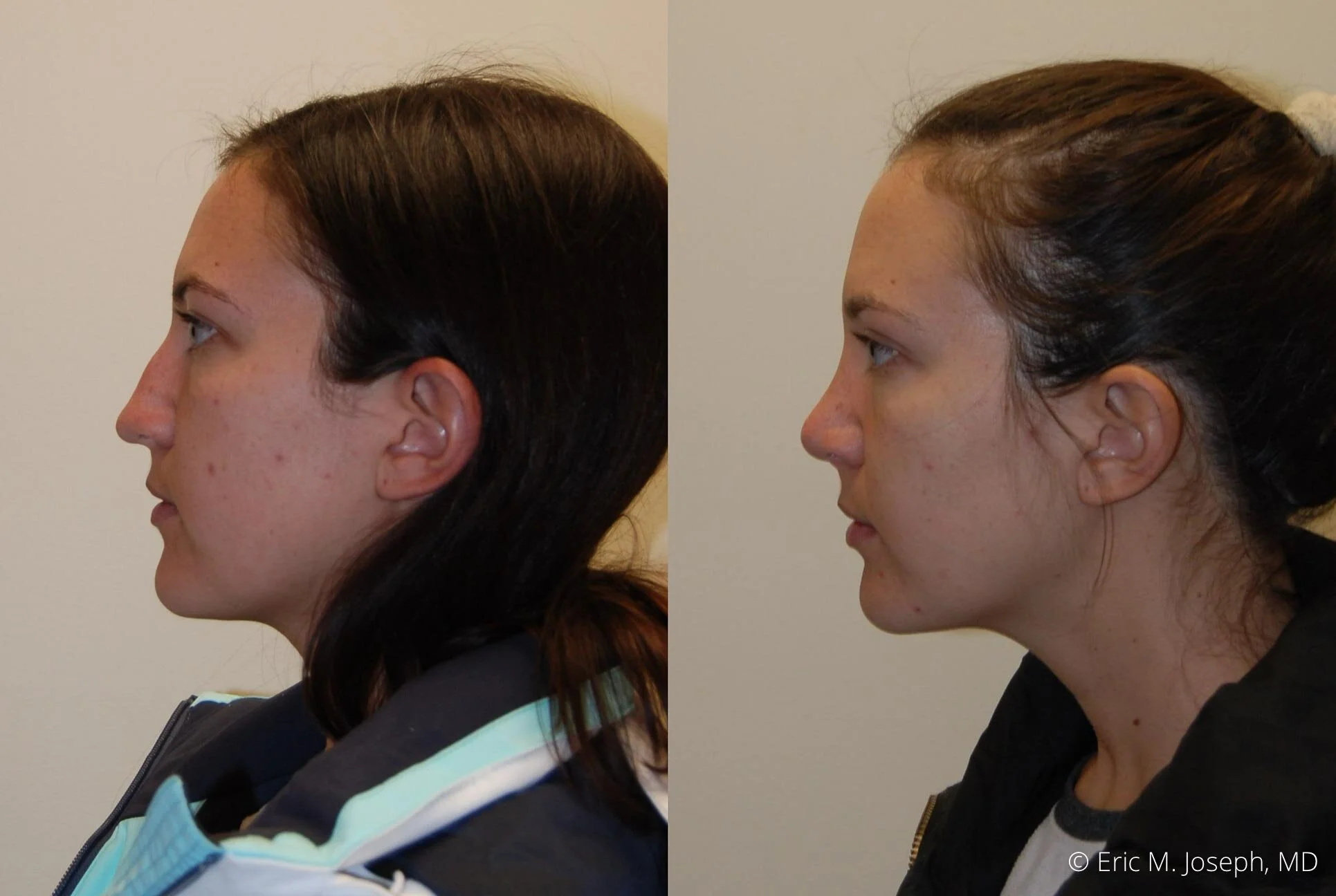nose-job-rhinoplasty-nj-nyc-0449.jpg