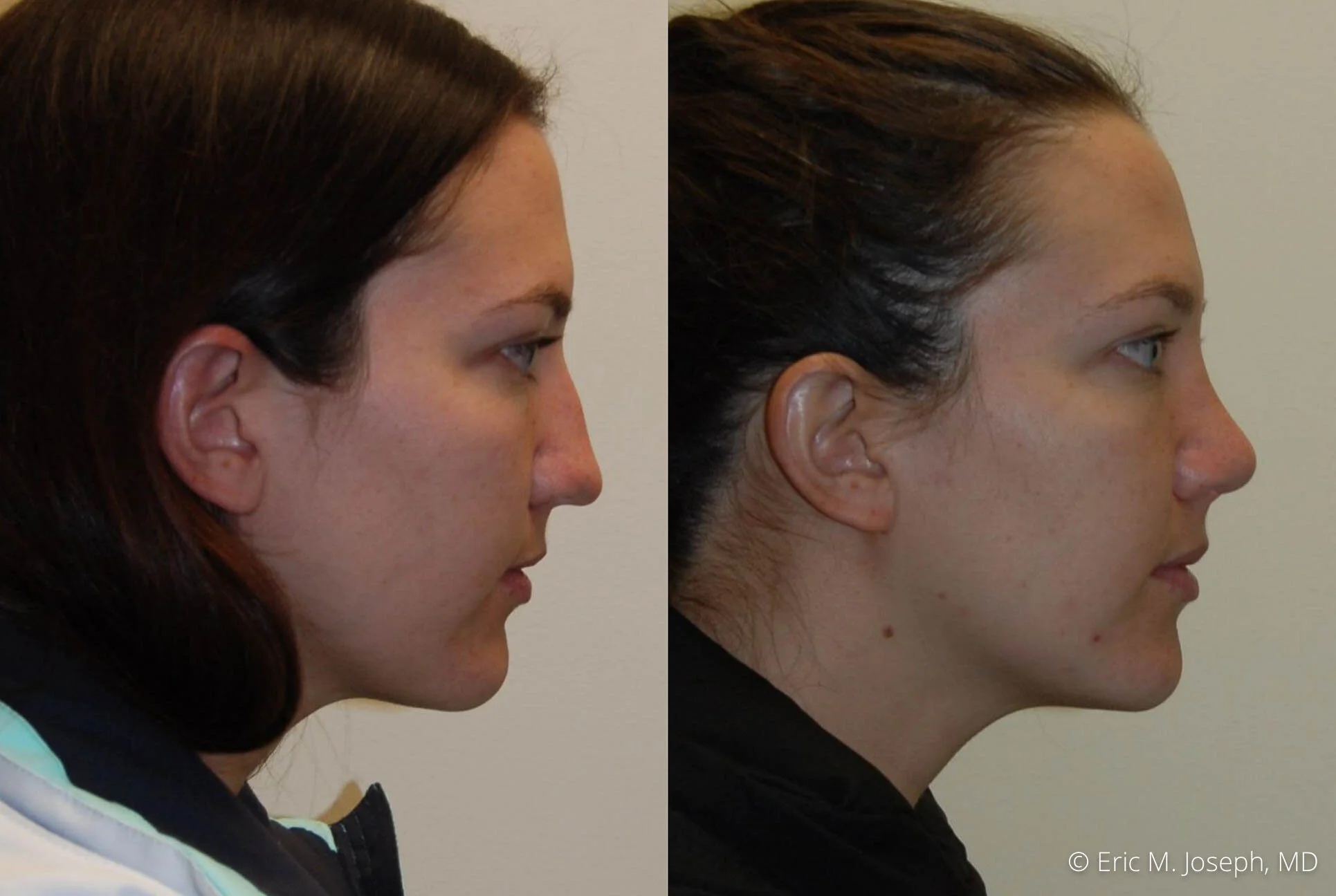 nose-job-rhinoplasty-nj-nyc-0450.jpg
