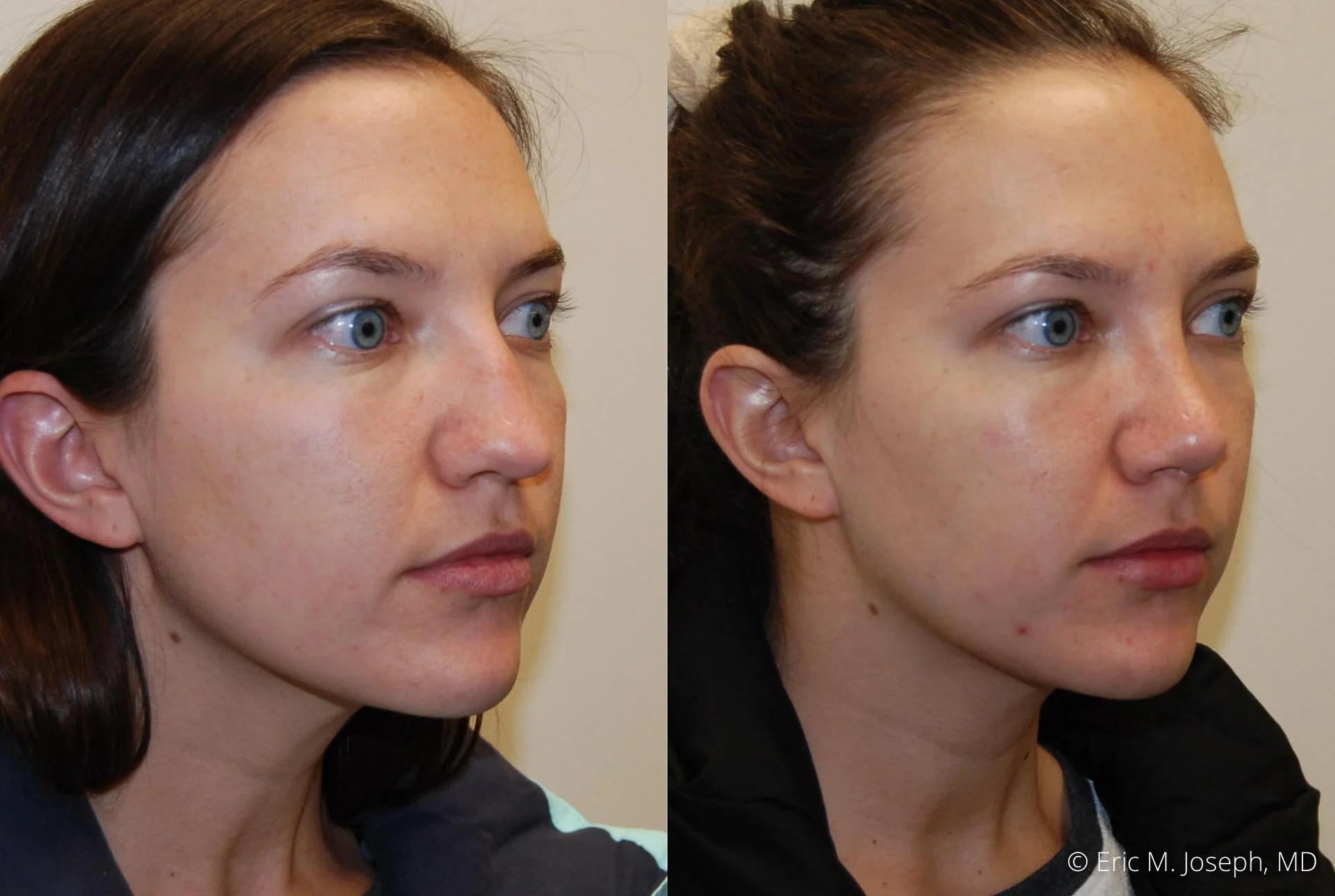 nose-job-rhinoplasty-nj-nyc-0453.jpg