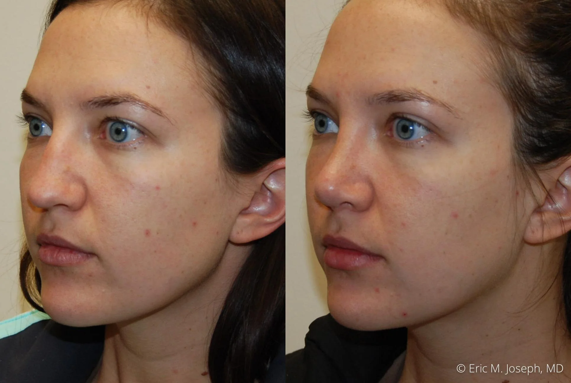 nose-job-rhinoplasty-nj-nyc-0454.jpg