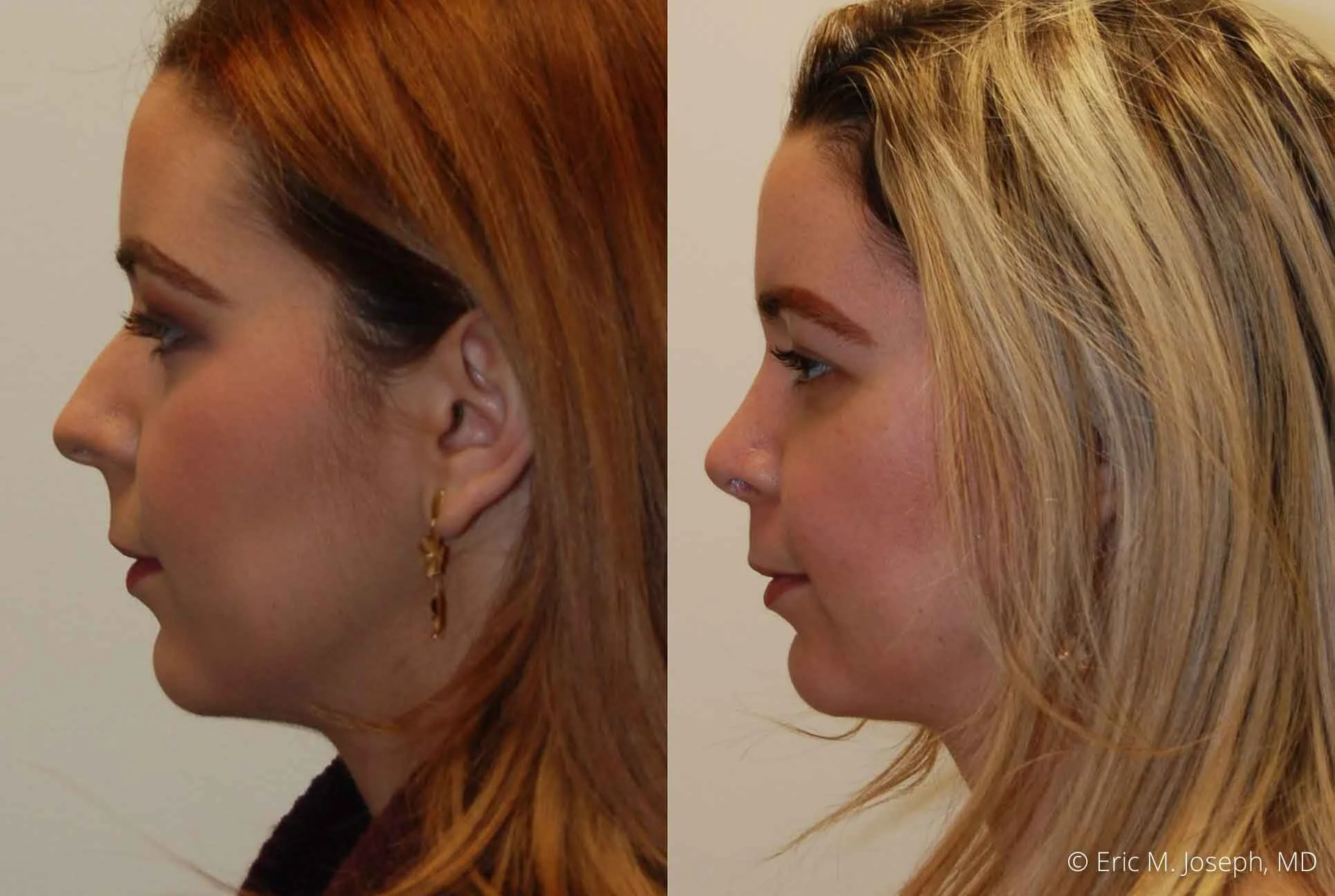 rhinoplasty-nj-nose-job-0546.jpg