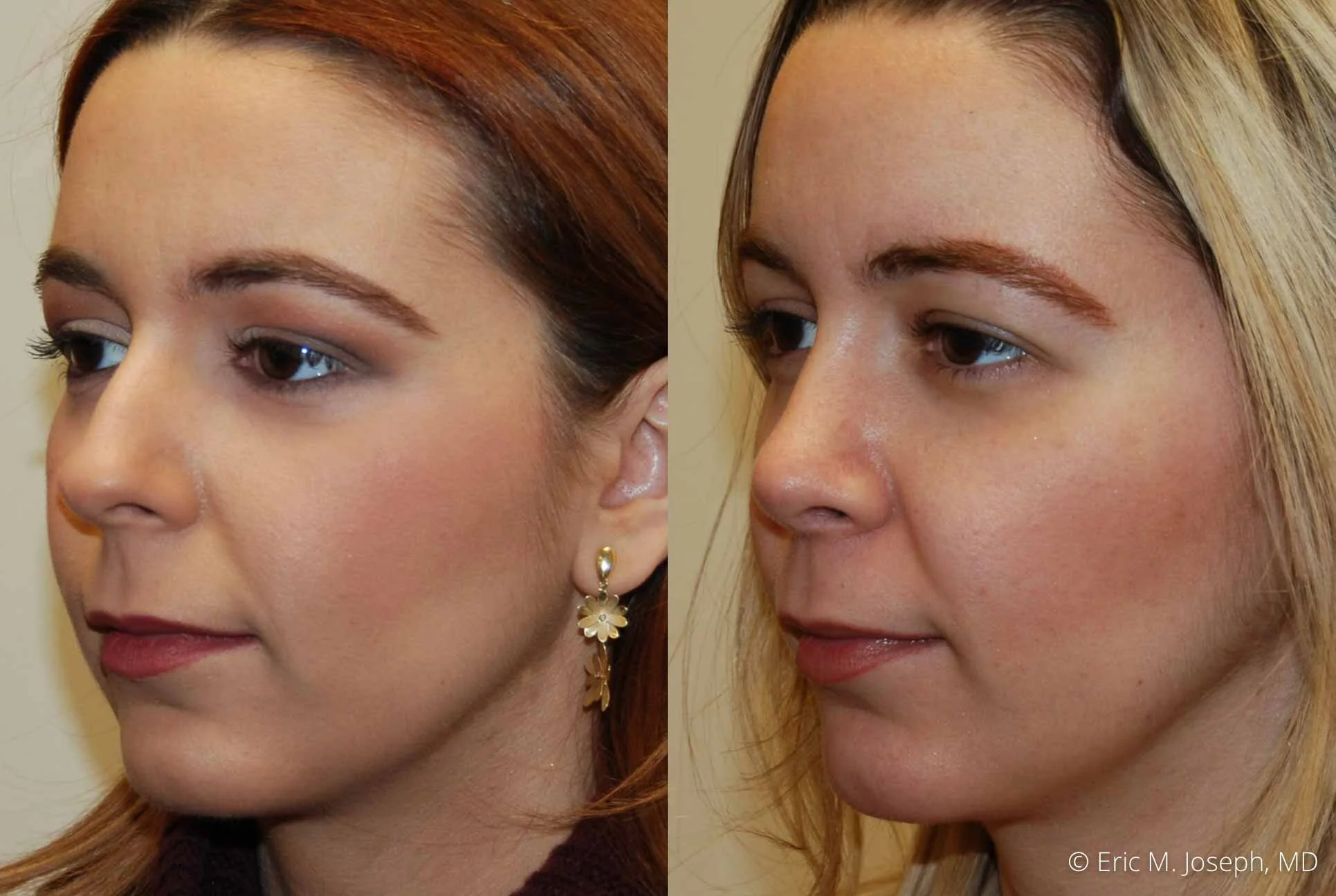 rhinoplasty-nj-nose-job-0547.jpg