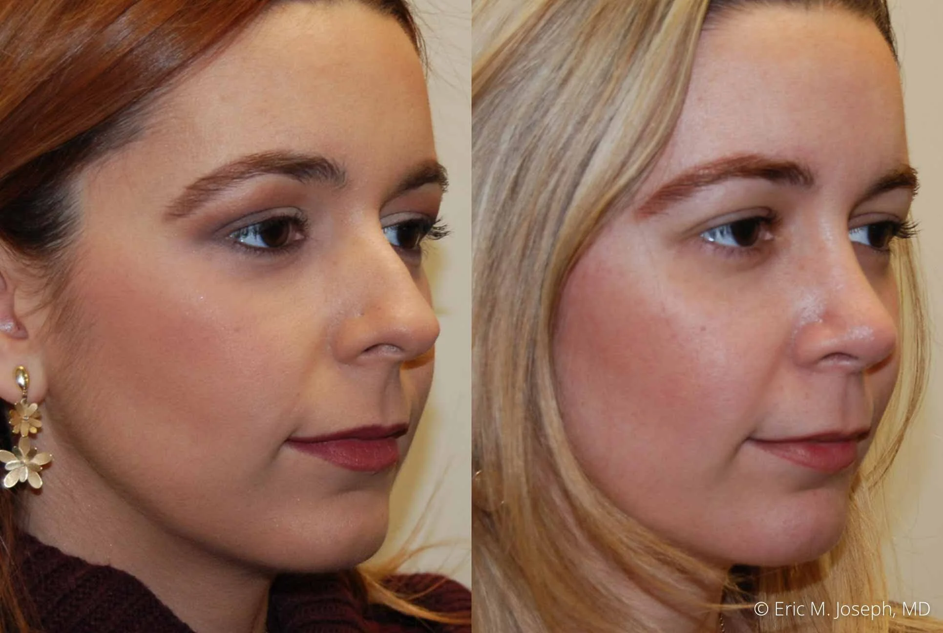 rhinoplasty-nj-nose-job-0548.jpg