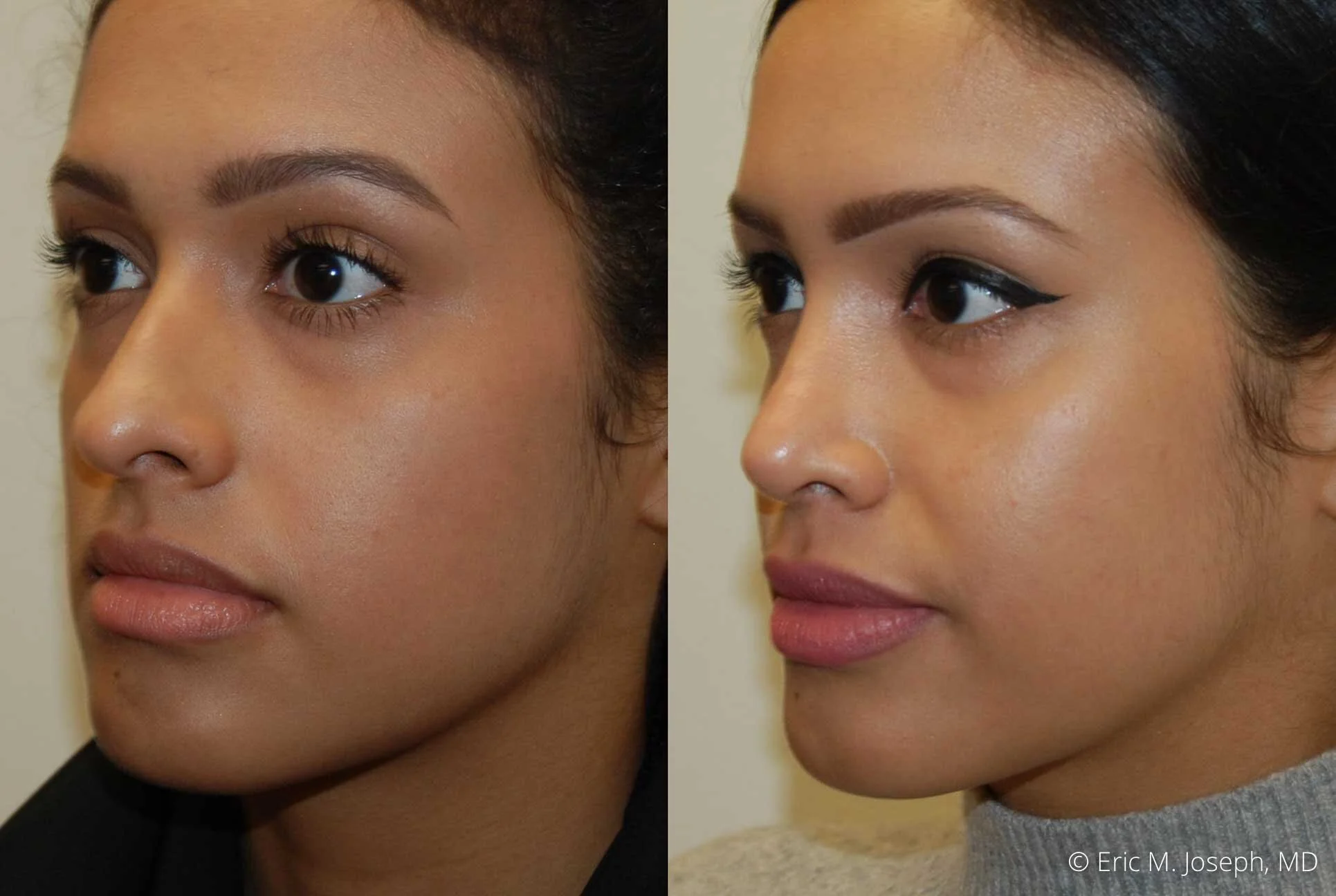 rhinoplasty-nj-0522.jpg