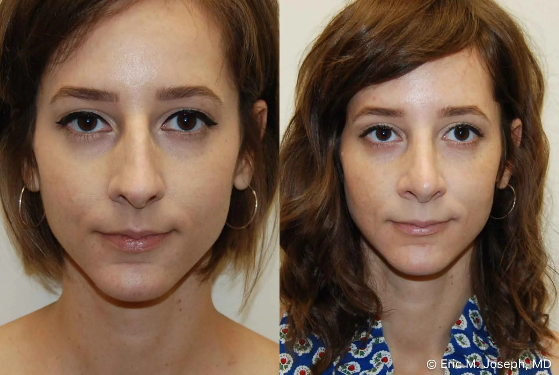 rhinoplasty-nj-nose-job-new-jersey-0585.jpg