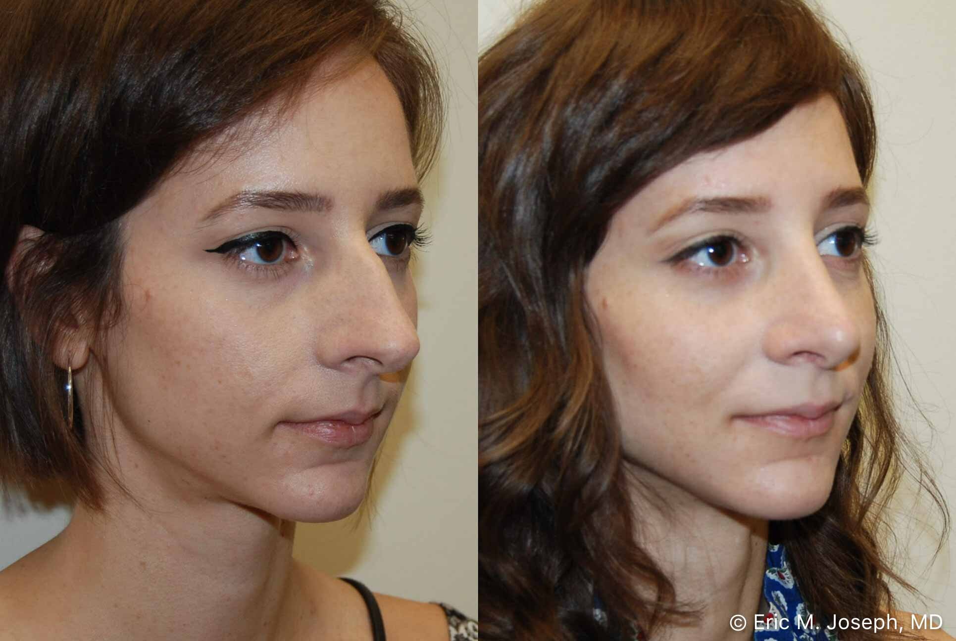 rhinoplasty-nj-nose-job-new-jersey-0586.jpg