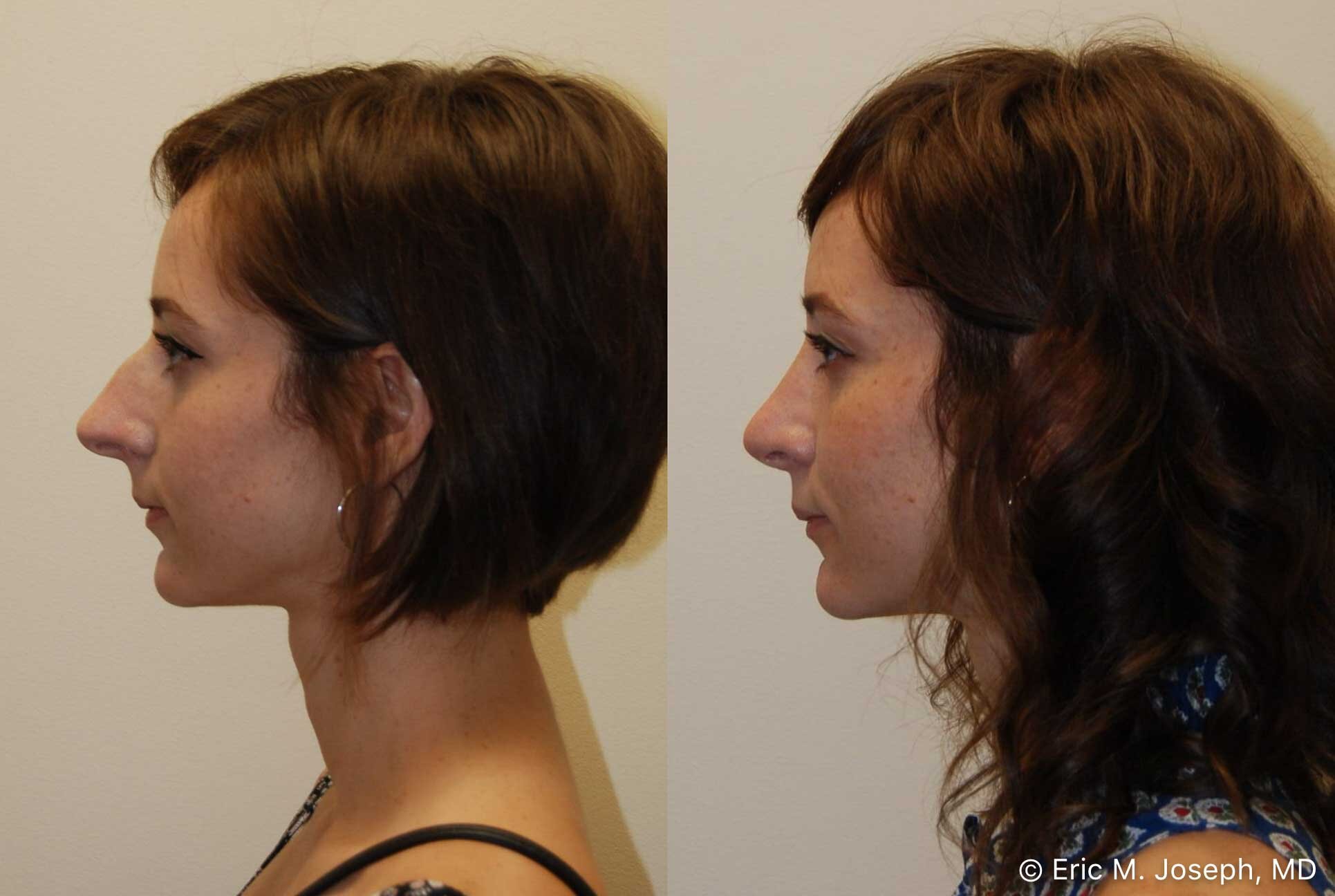 rhinoplasty-nj-nose-job-new-jersey-0588.jpg