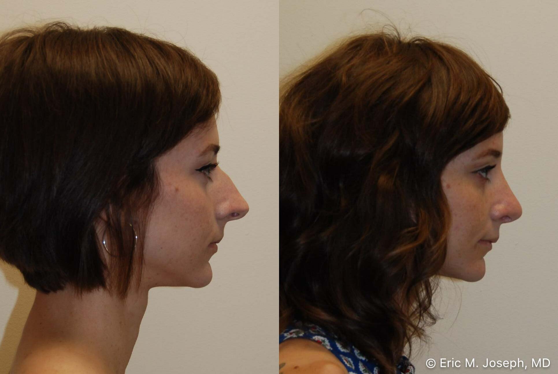 rhinoplasty-nj-nose-job-new-jersey-0589.jpg