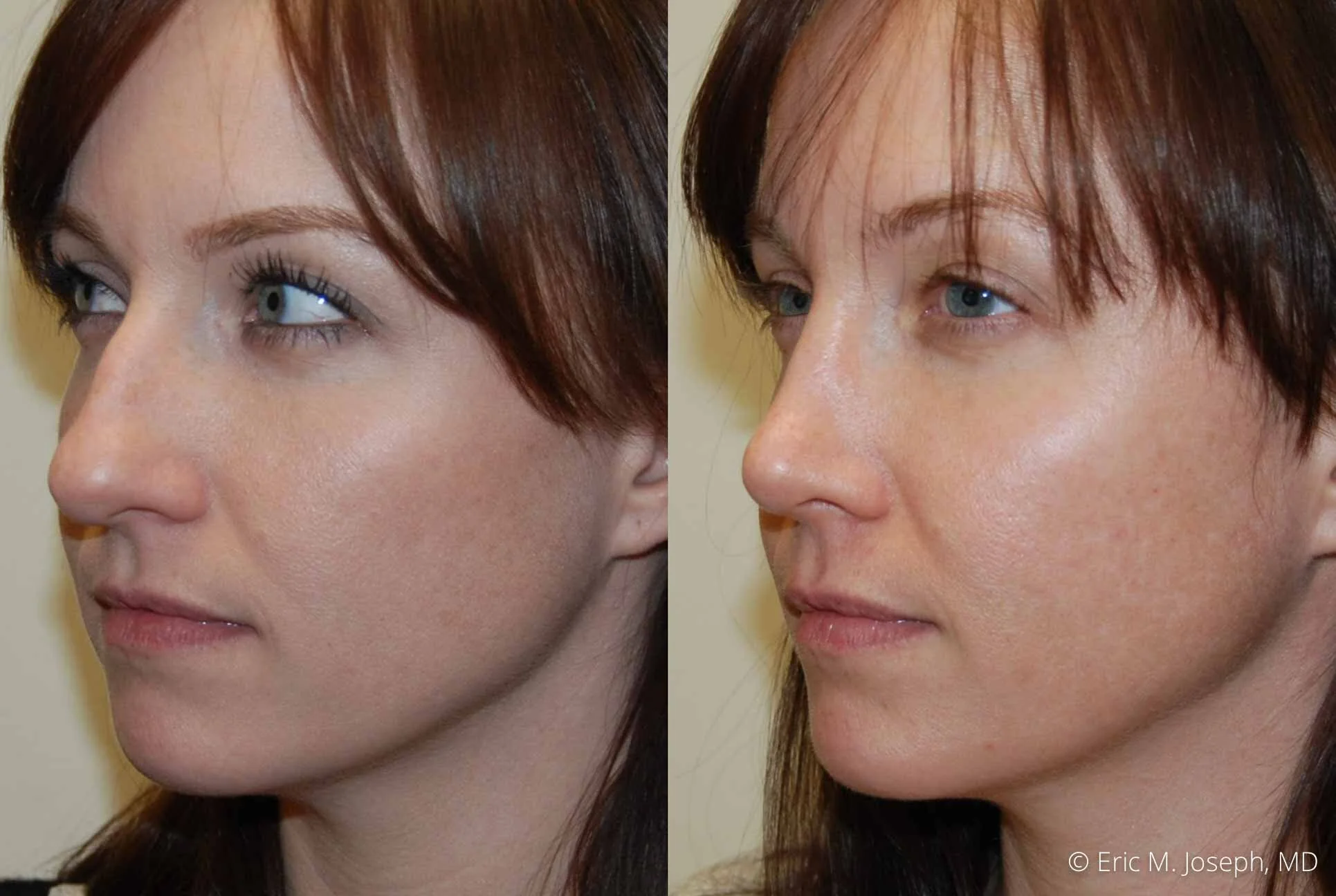 rhinoplasty-nj-nose-job-nyc-0551.jpg